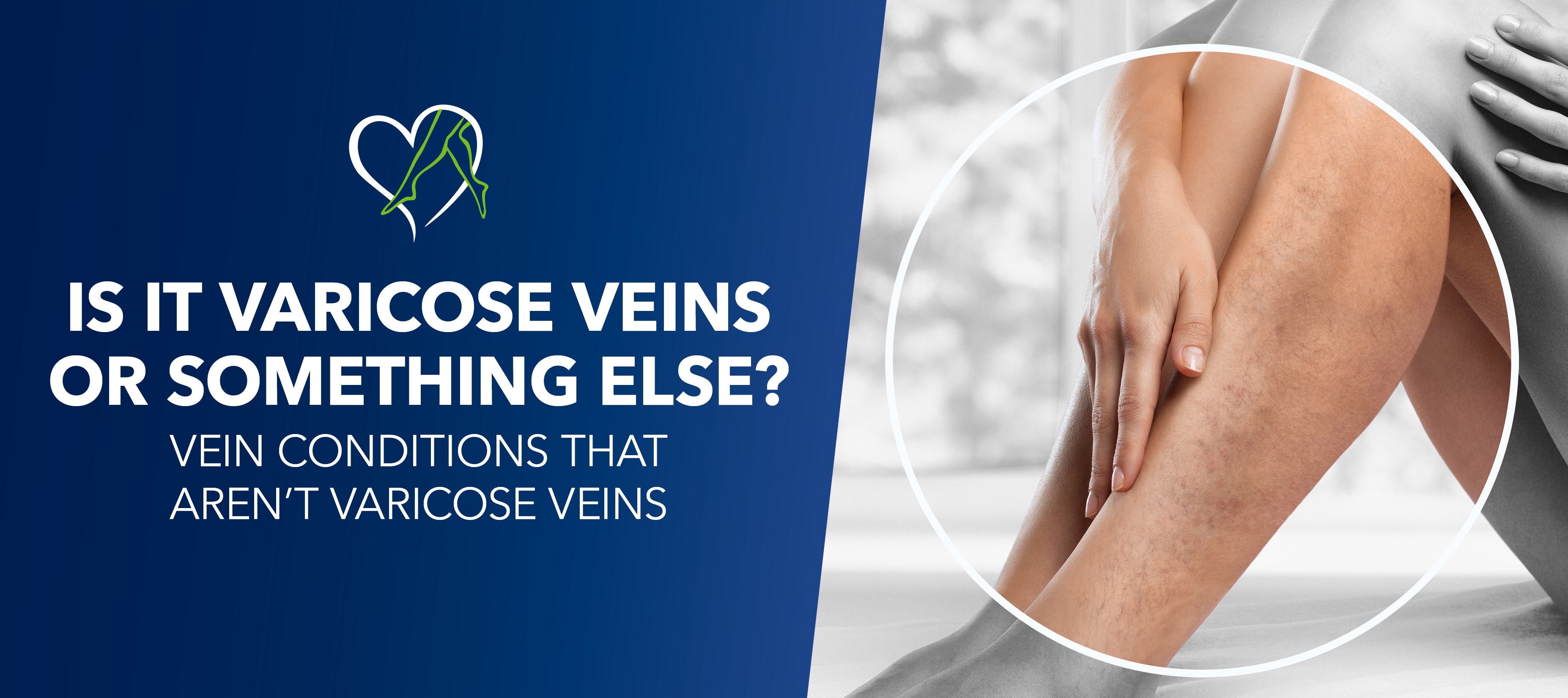 Blog Image Is It Varicose Veins Or Something Else
