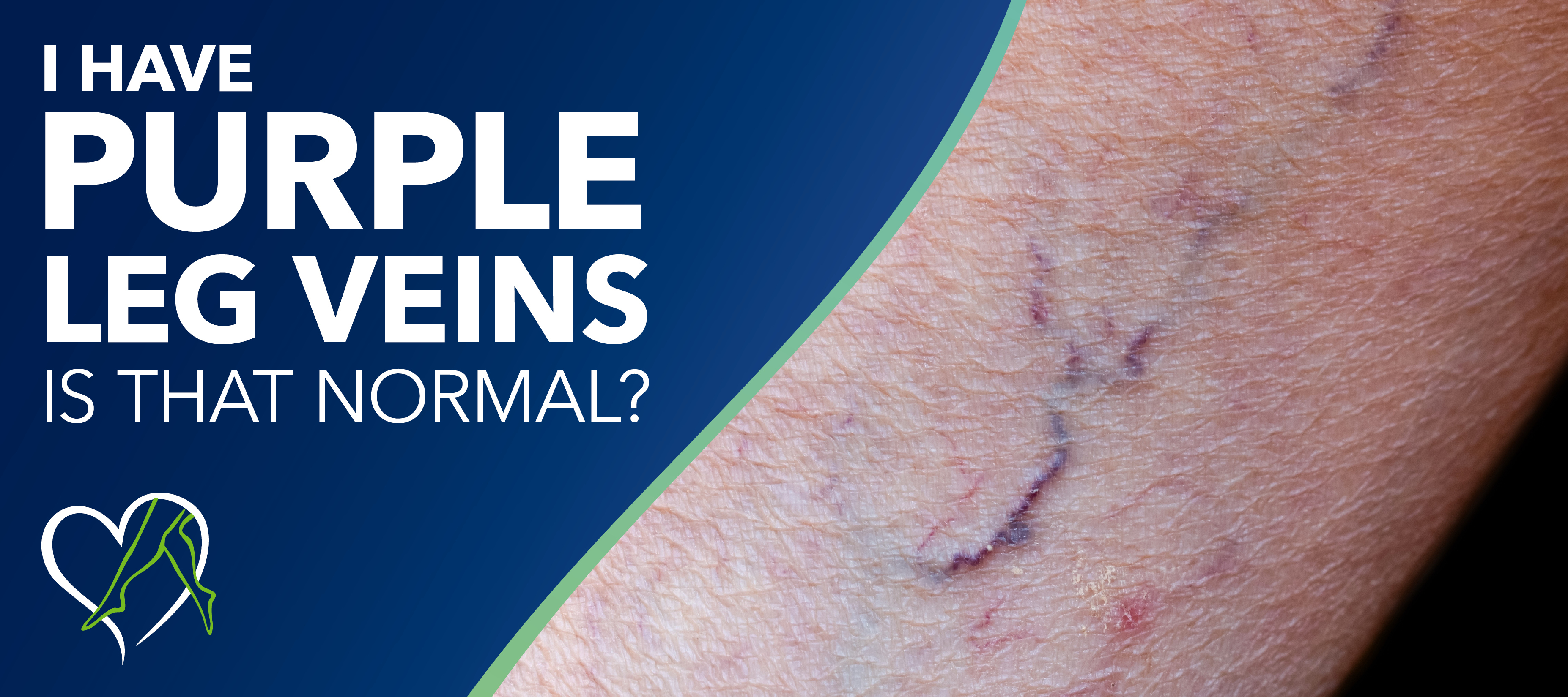 Purple Pressure Rash Purple Vein Like Rash
