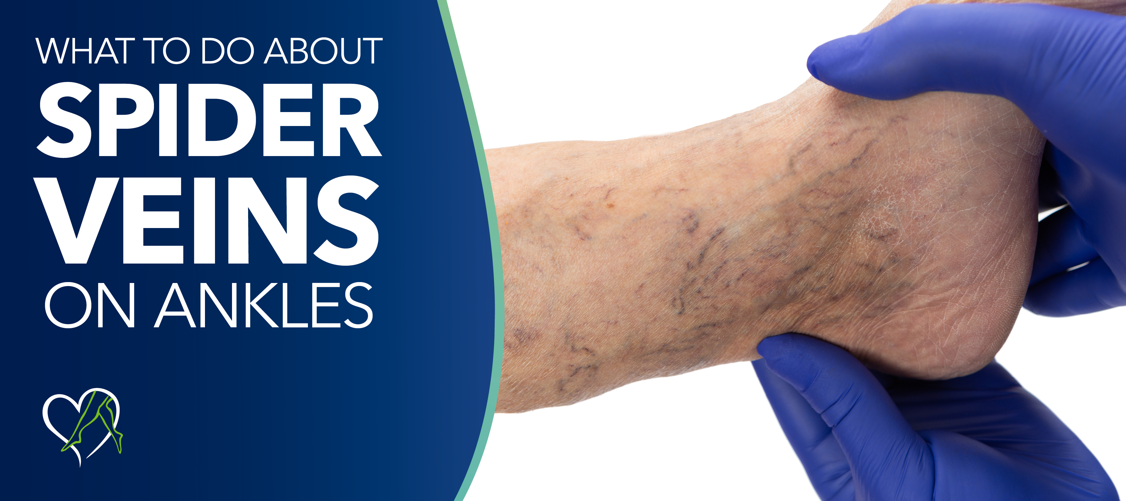Blog Image Spider Veins Ankles