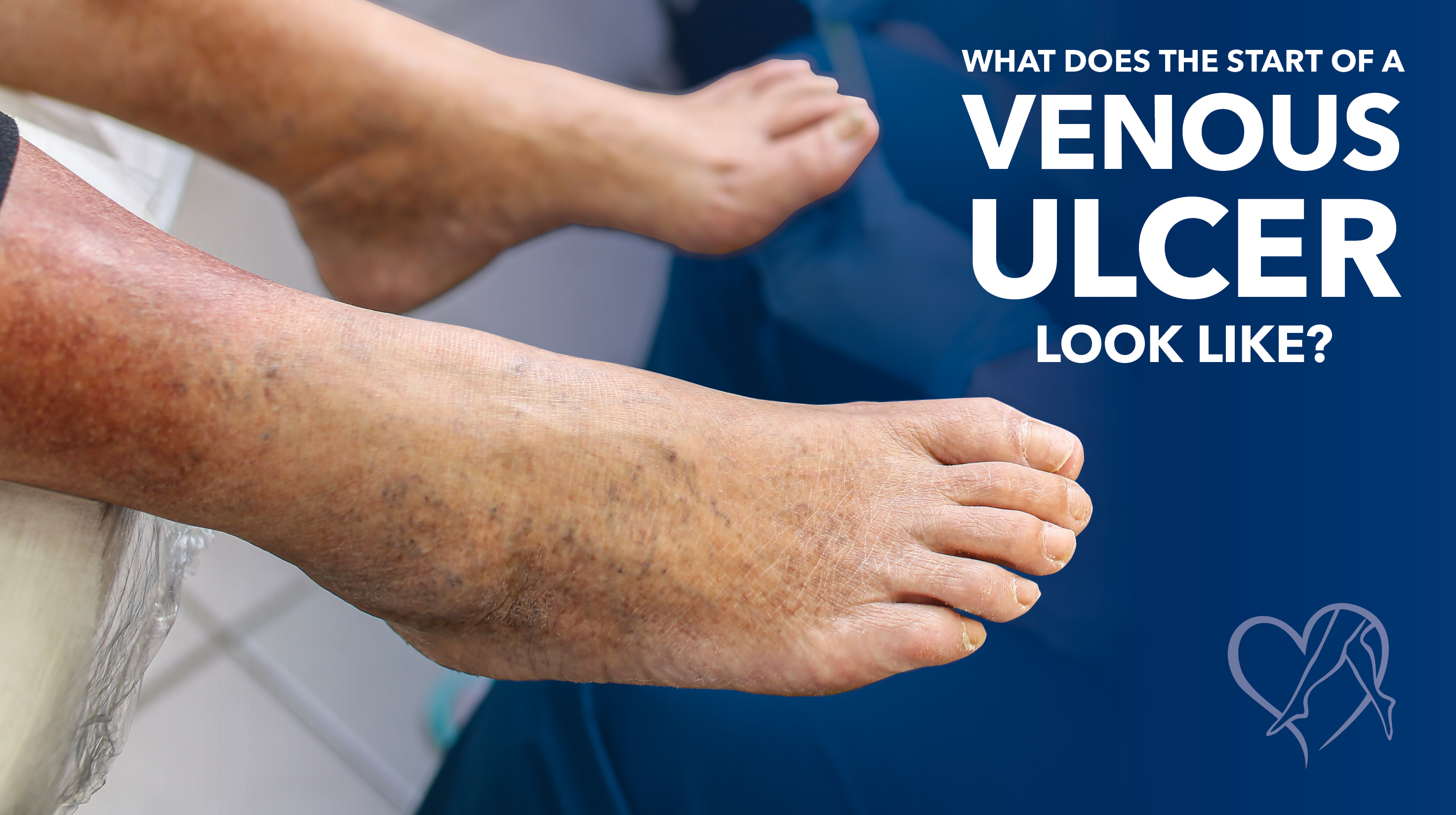 Blog Image Start Of Venous Ulcer Thumbnail