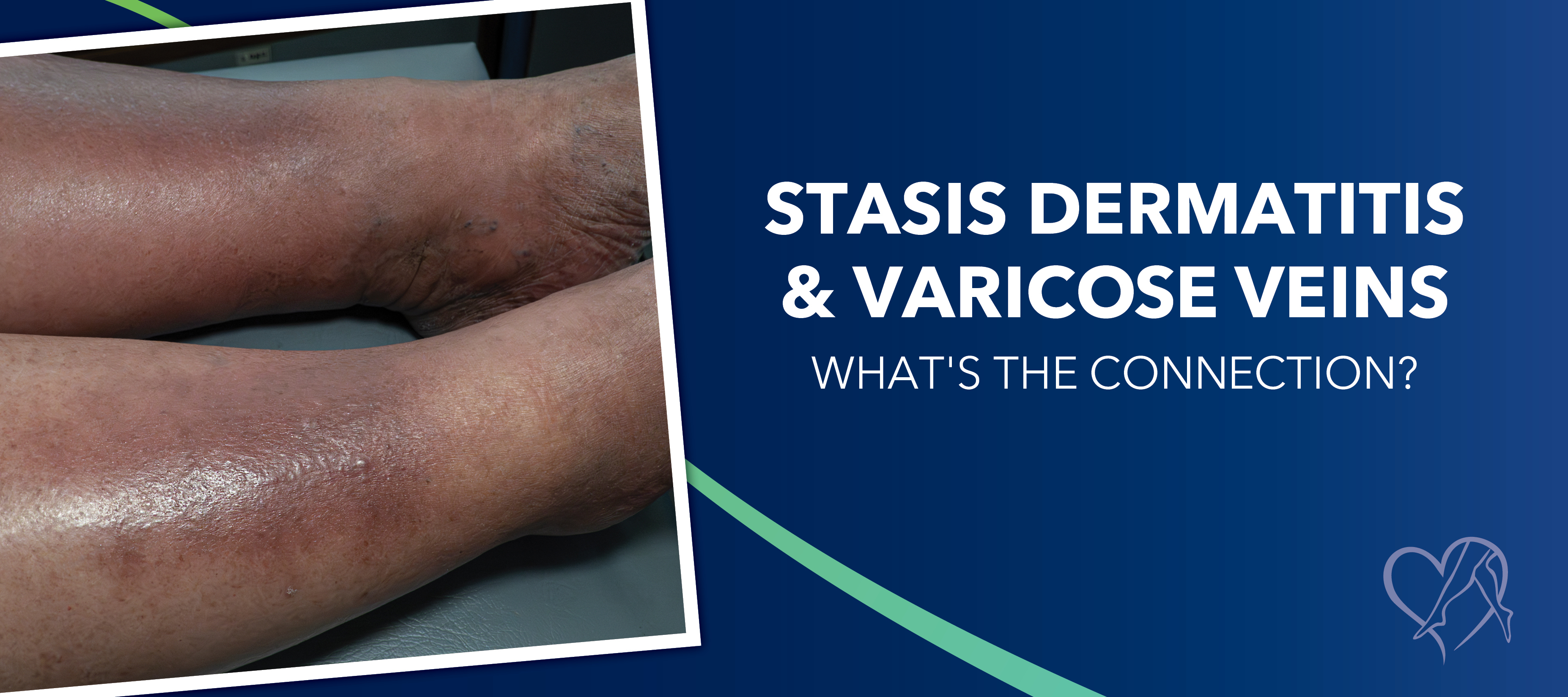 Blog Image Statis Dermatitis