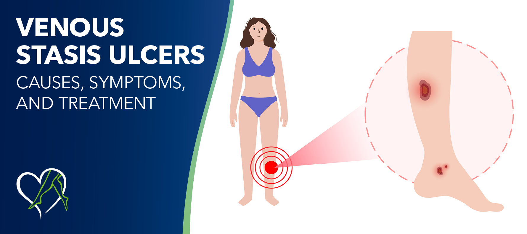 https://cdn.craft.cloud/4f7c8d17-0c96-40cd-89a4-3f6a0150b271/assets/images/Blog-Image_VenousStasisUlcers.jpg?width=360&quality=80&fit=contain&s=GsYTi9amDEdLsxoCmH-2JkVENN2x6mABHEXBQcH8z1w