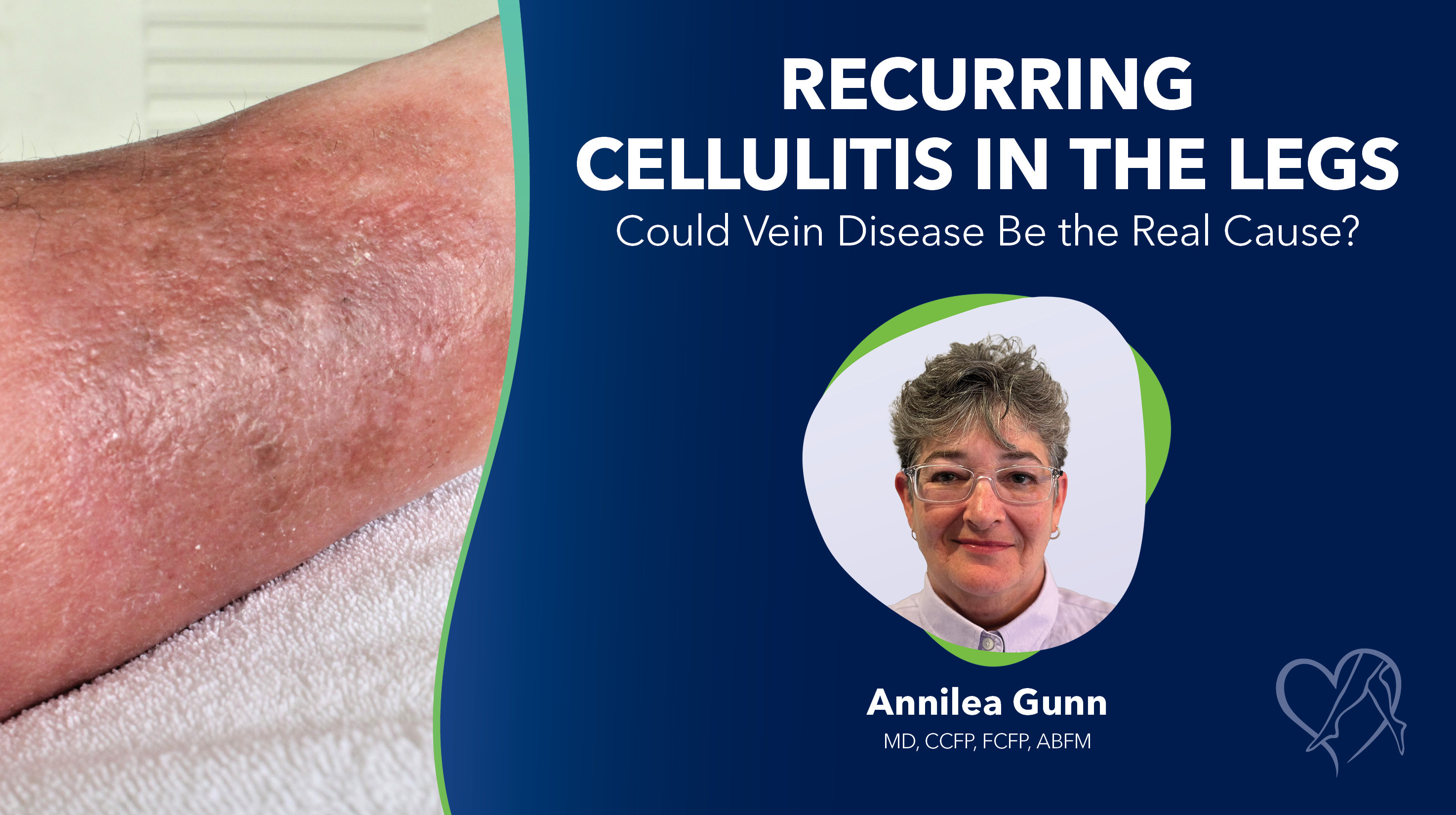Blog Image Recurring Cellulitis in the Legs Thumbnail