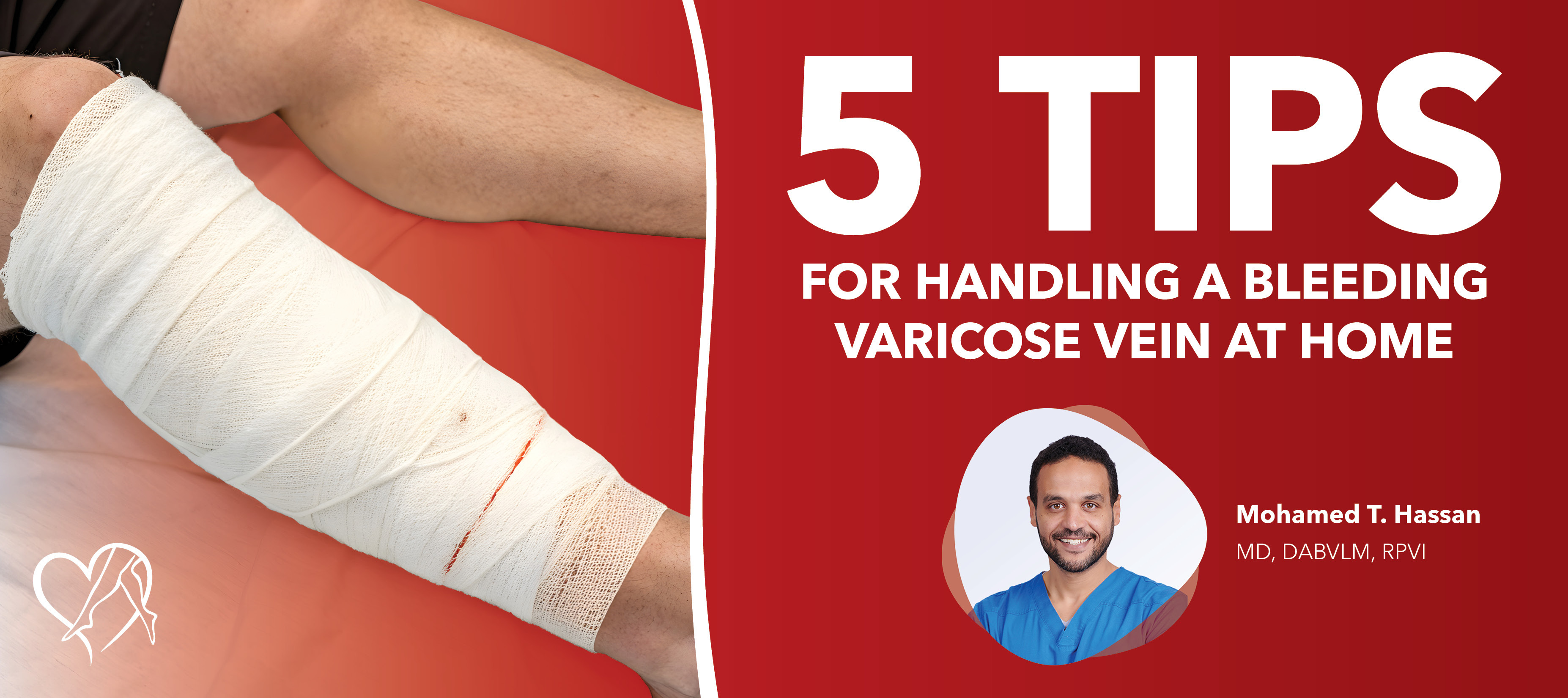 Blog Image 5 Tips Bleeding Varicose Vein
