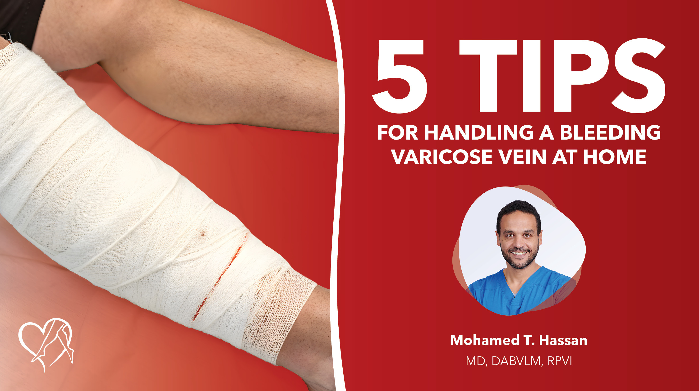 Blog Image 5 Tips Bleeding Varicose Vein Thumbnail
