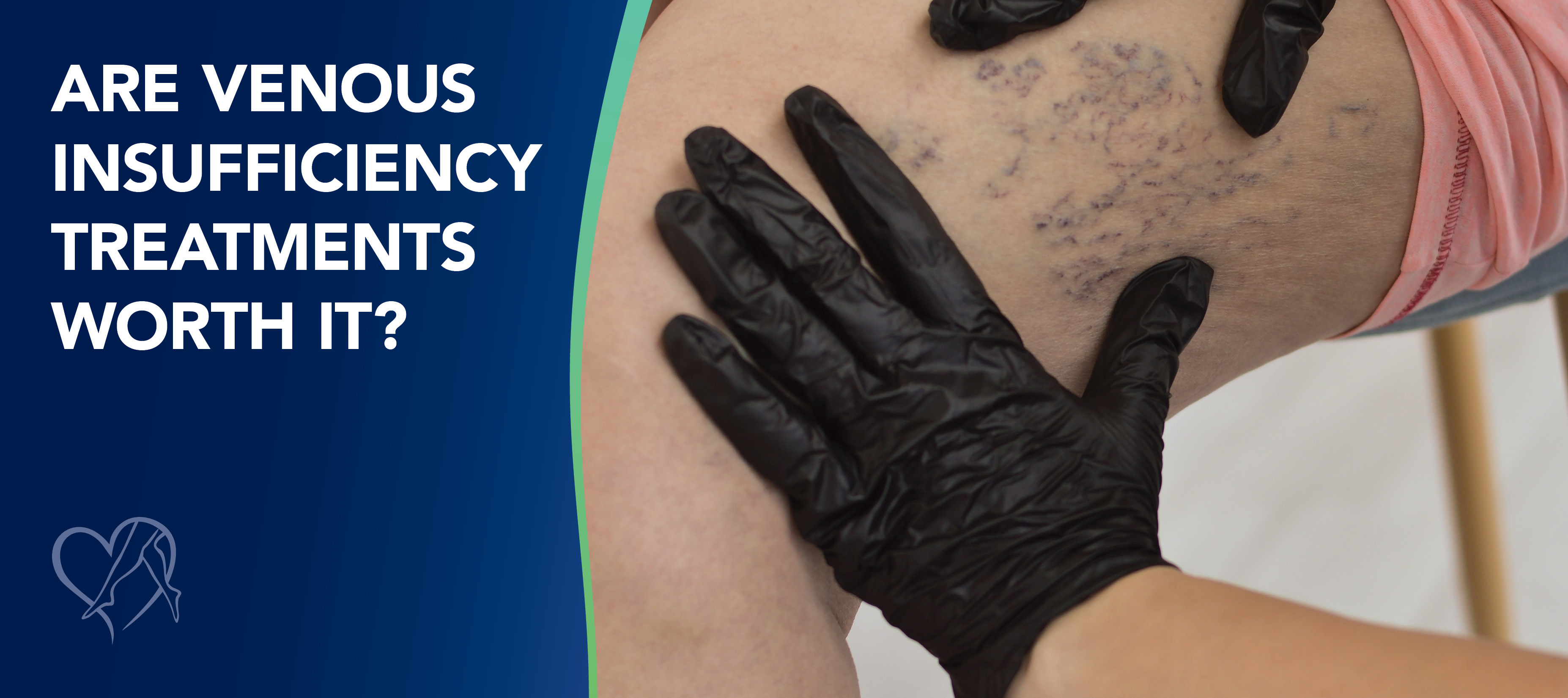 Blog Image Are Venous Insufficiency Treatments Worth It