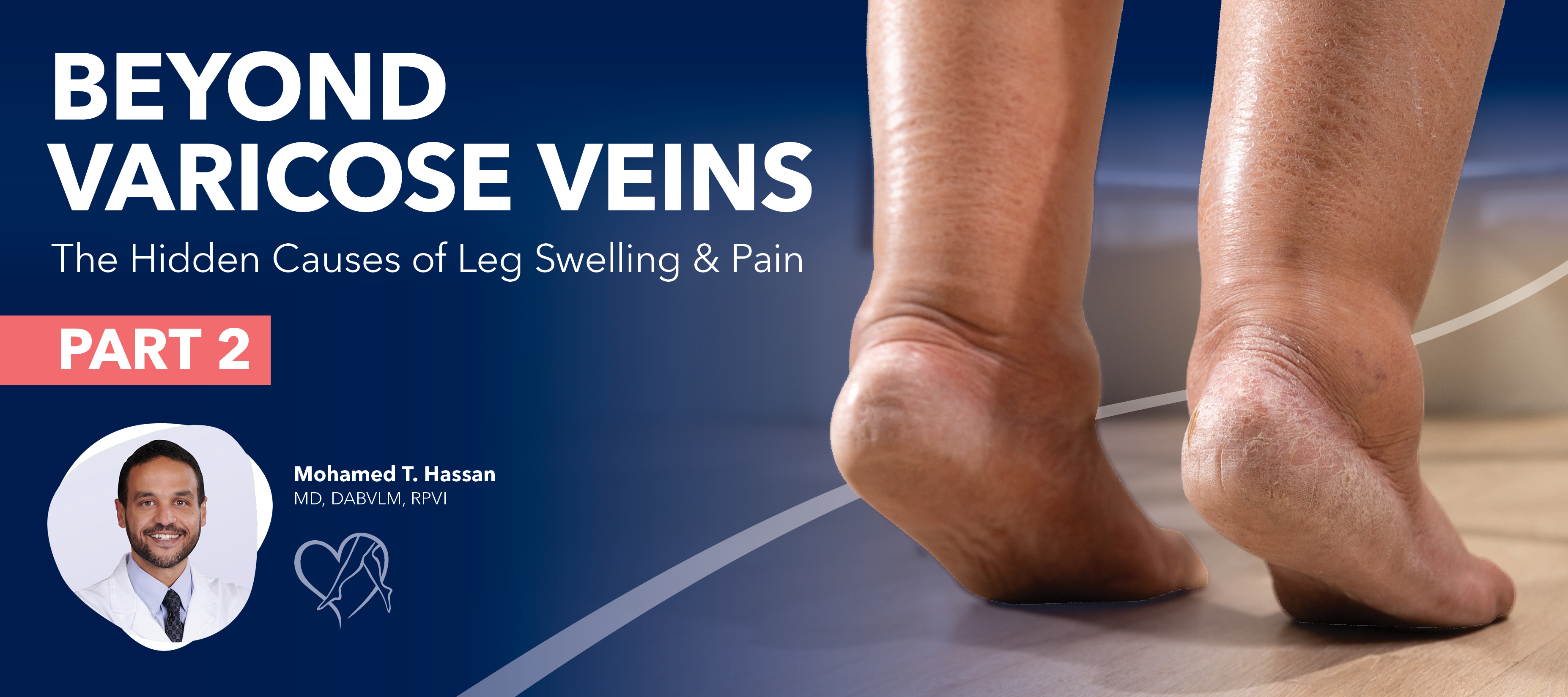 Blog Image Beyond Varicose Veins Part2