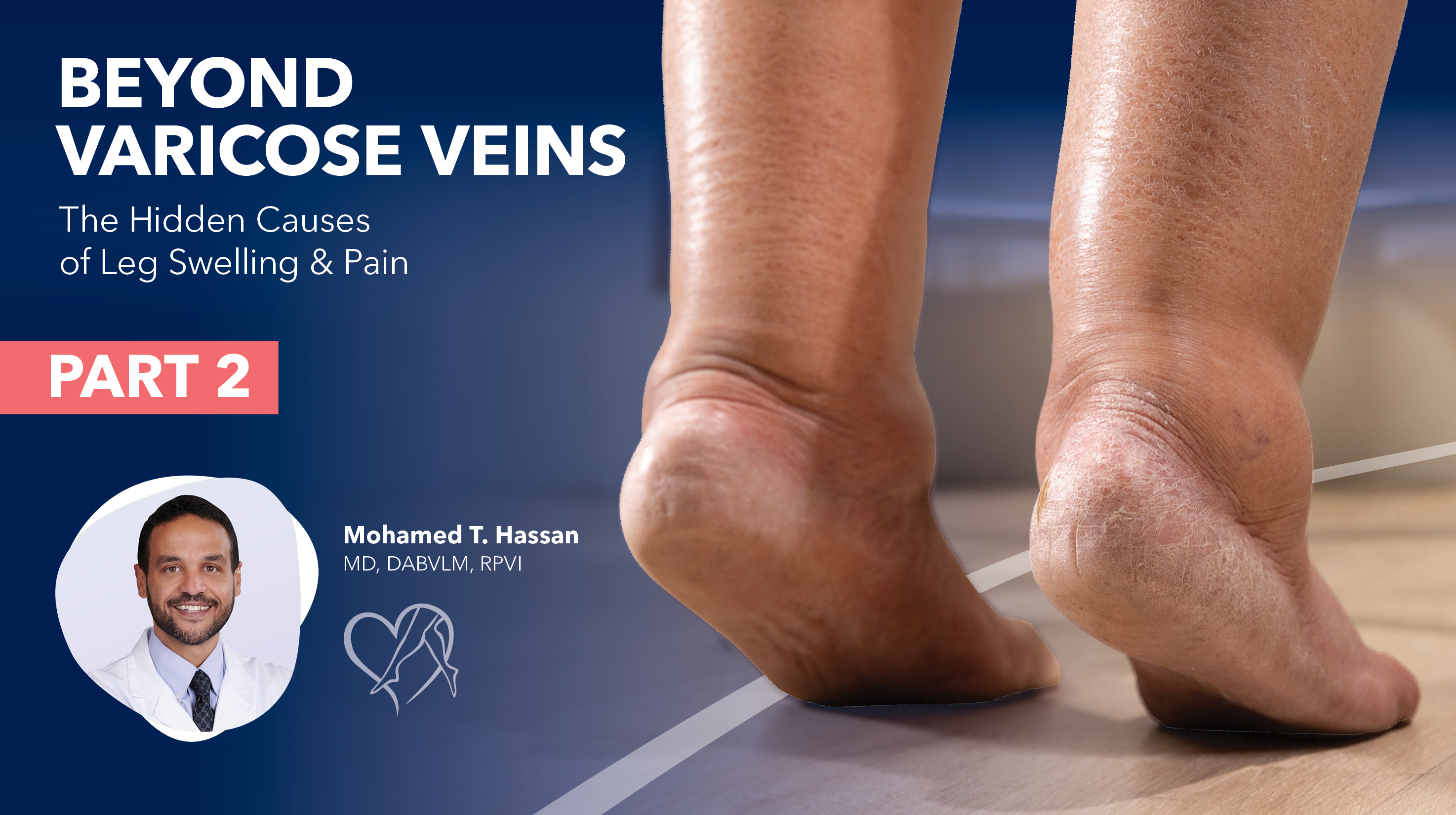 Blog Image Beyond Varicose Veins Part2 Thumbnail