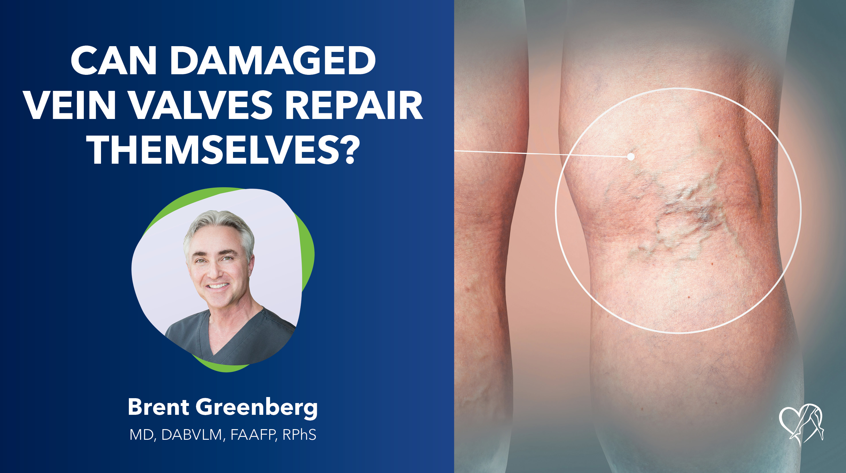 Blog Image Can Damaged Vein Valves Repair Themselves Thumbnail