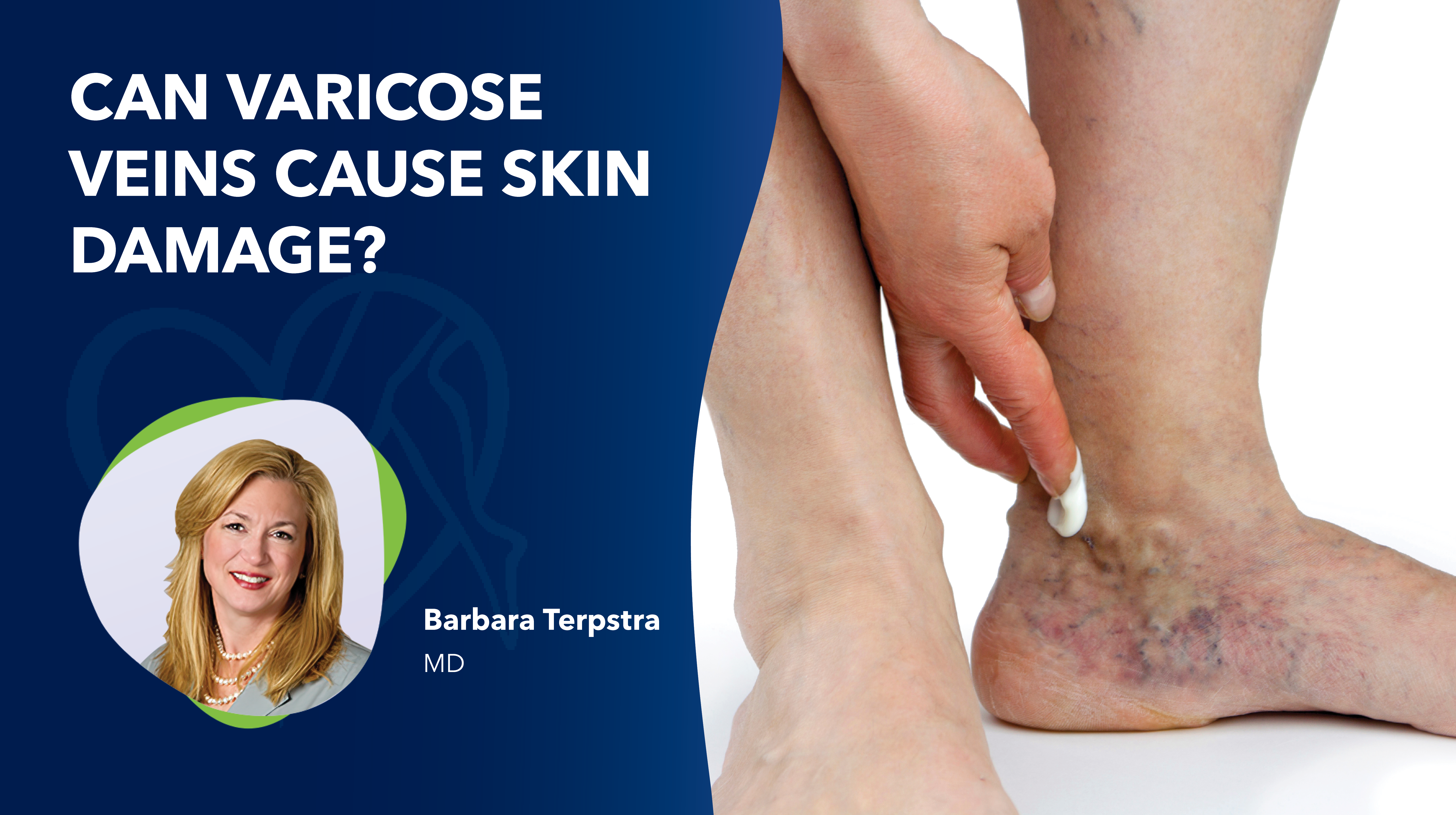Blog Image Can Varicose Veins Cause Skin Damage thumbnail