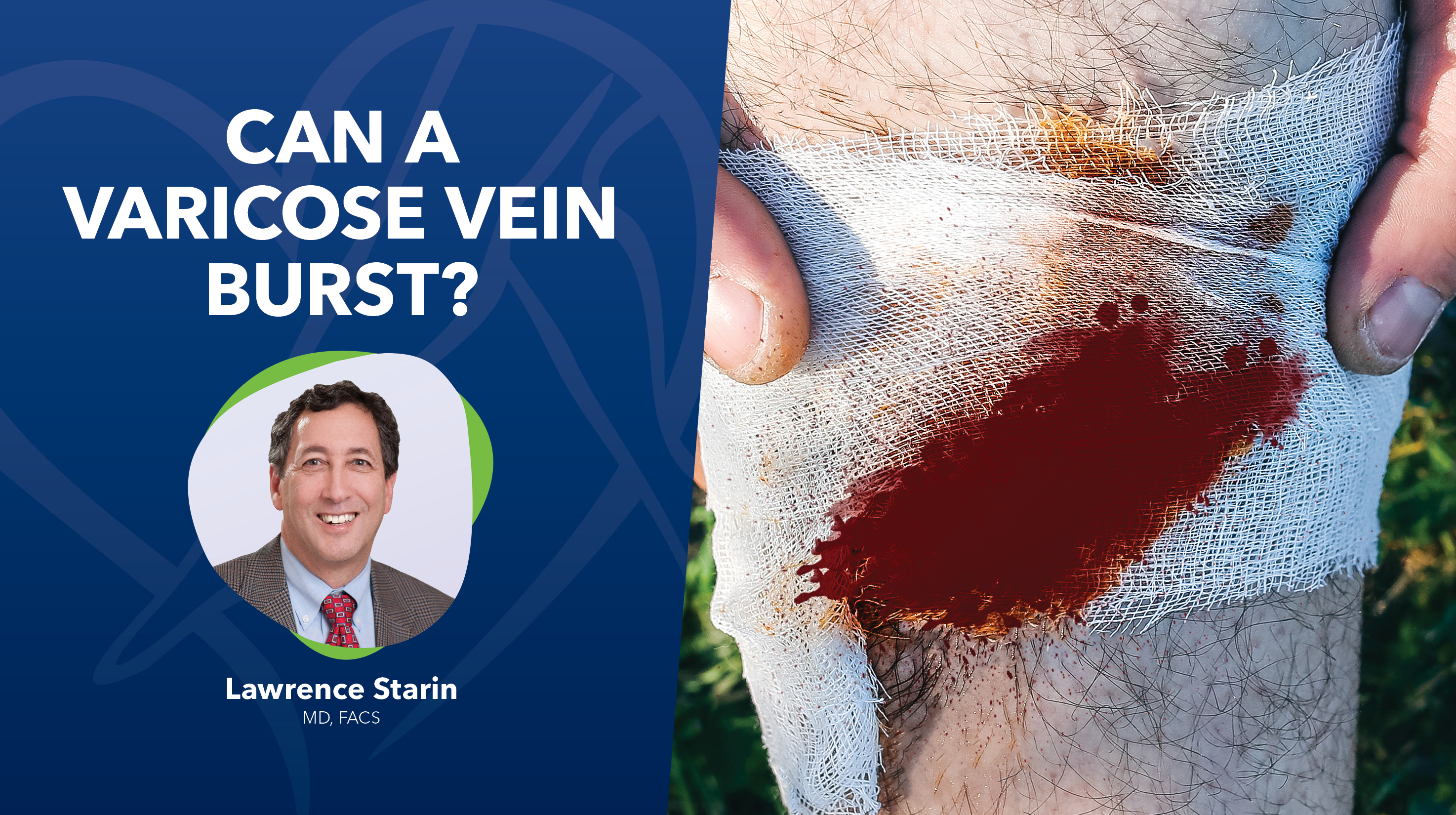 Leg Swelling and Varicose Veins: What's the Connection?
