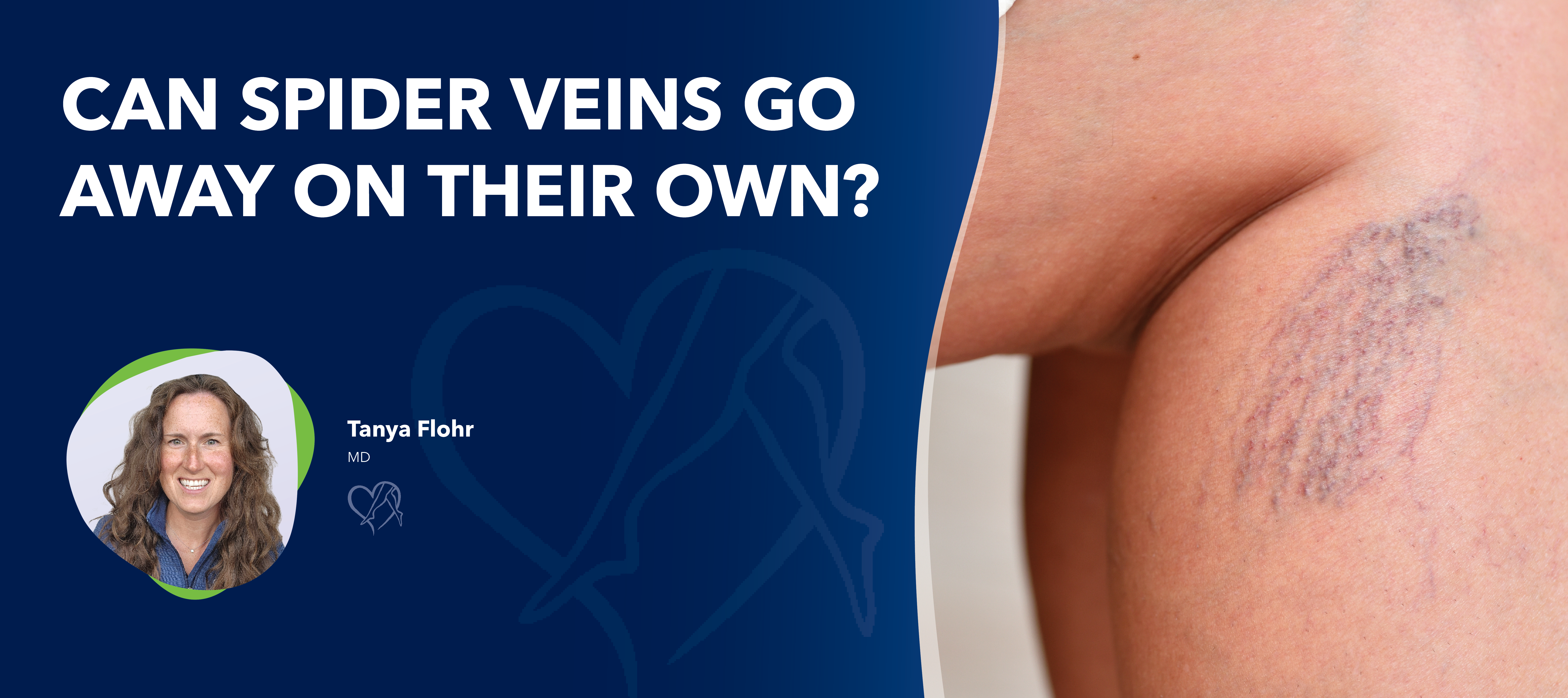 Blog Image Can Spider Veins Go Awayon Their Own