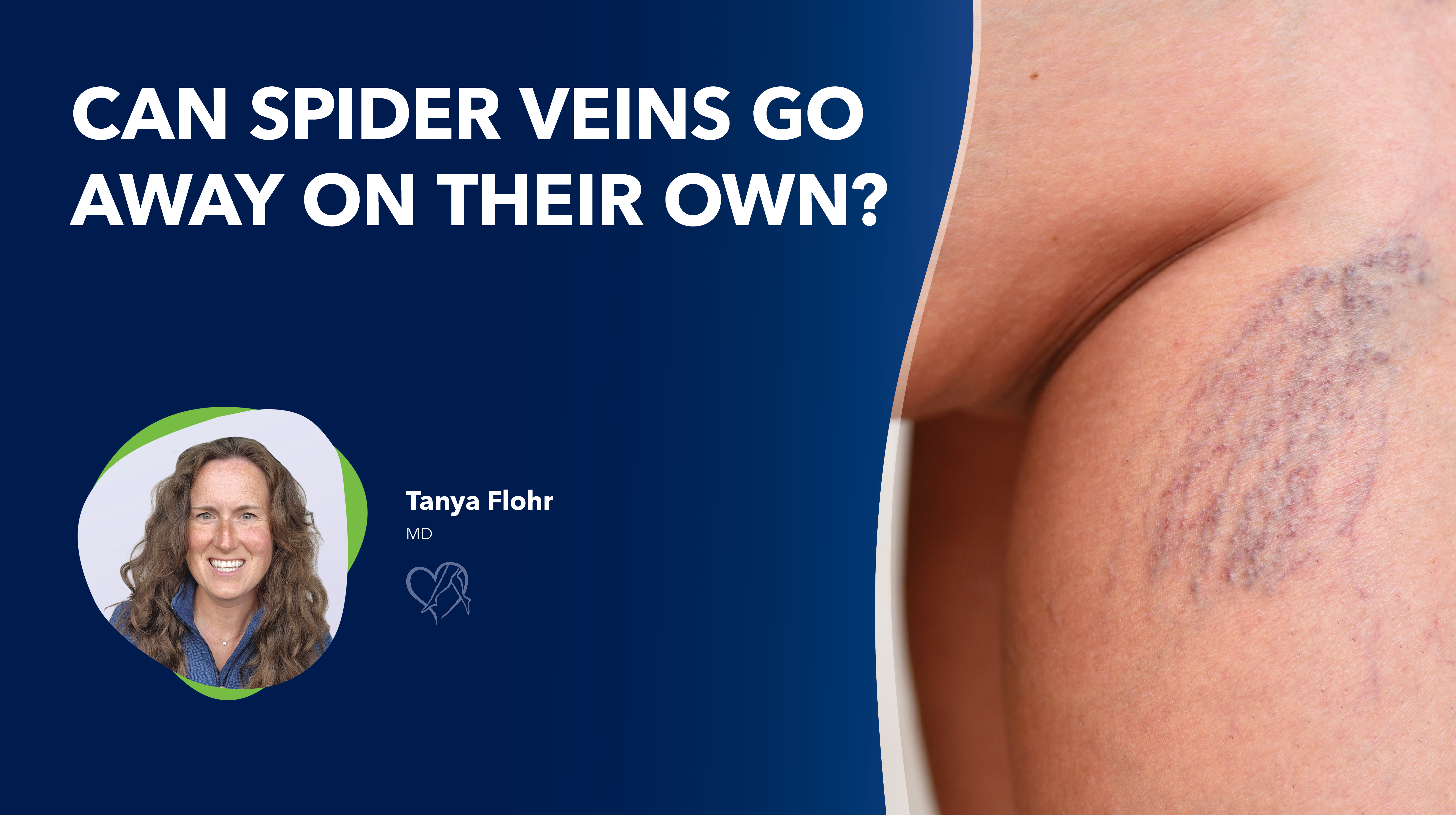 Blog Image Can Spider Veins Go Awayon Their Own Thumbnail