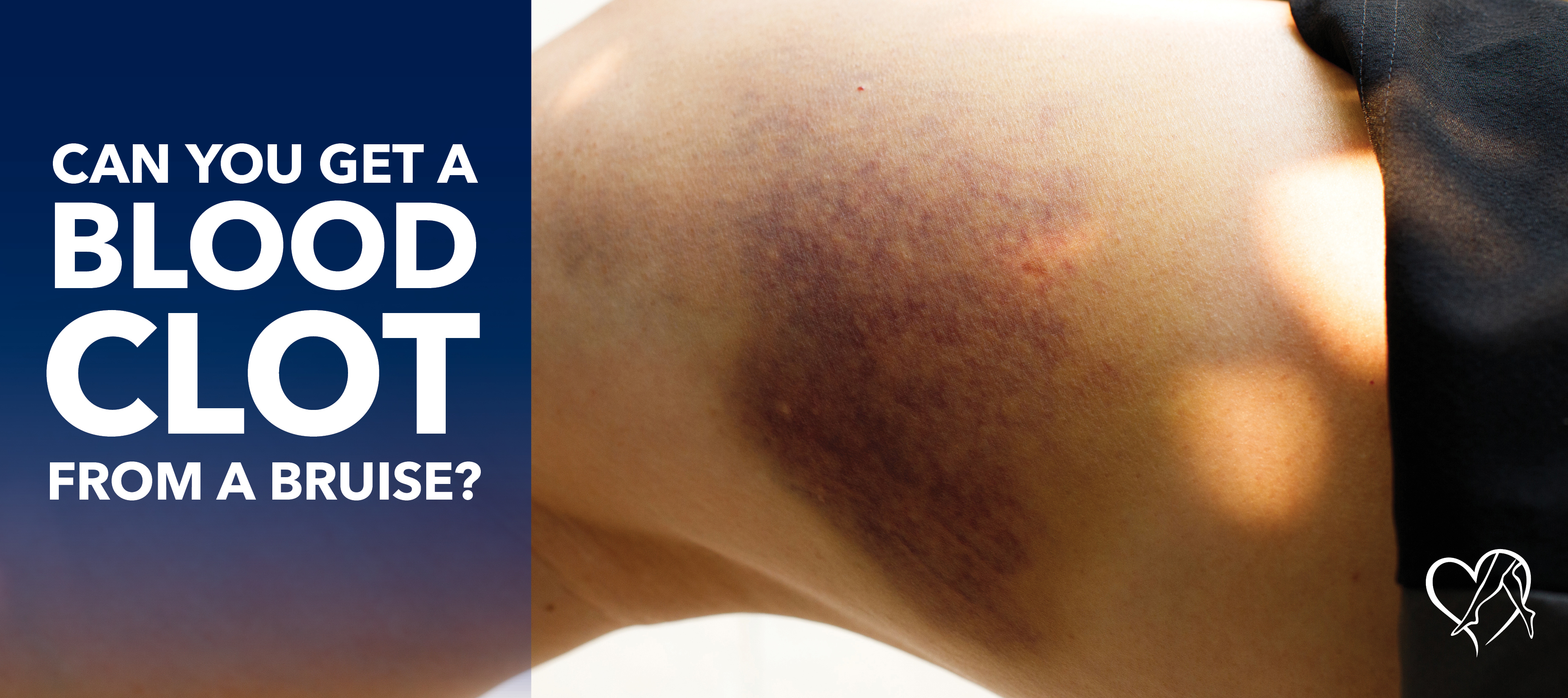 Blog Image Can You Get A Blood Clot From A Bruise