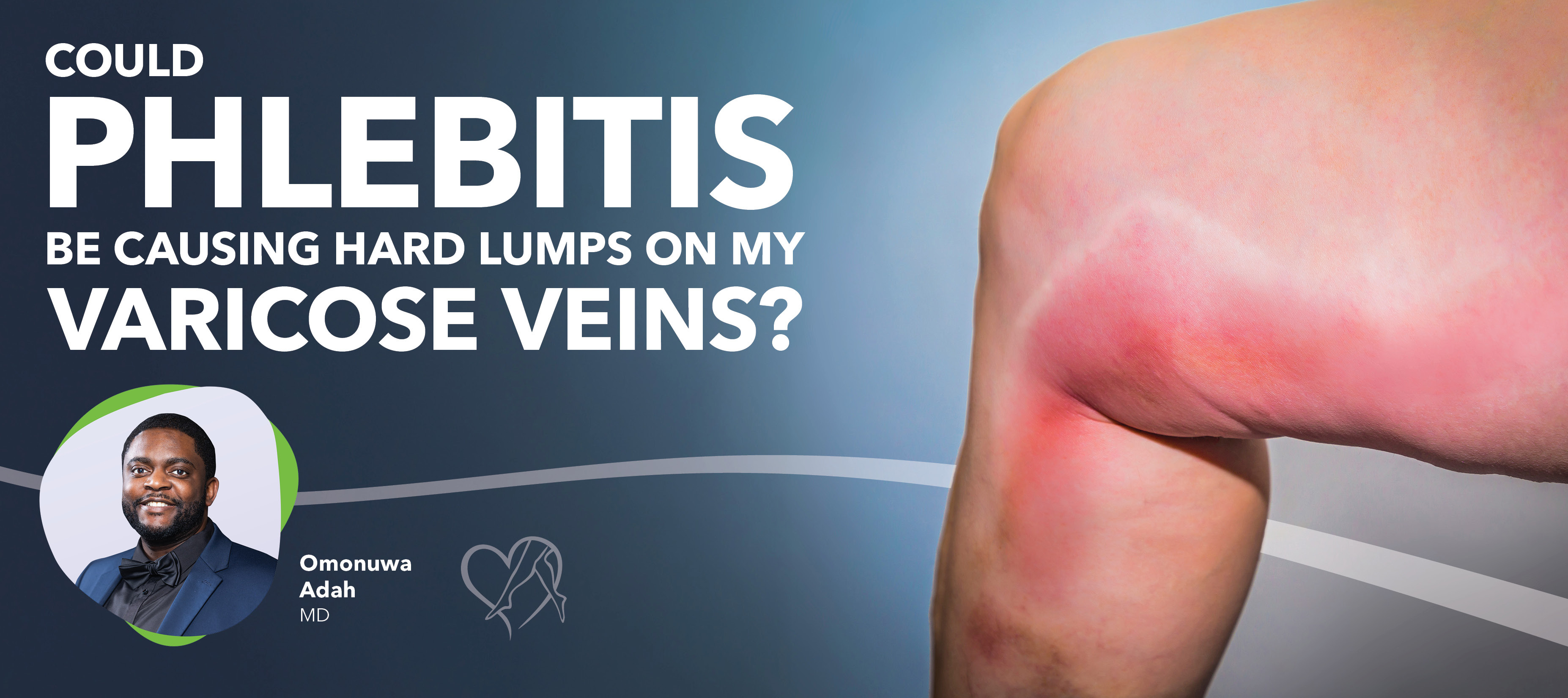 Blog Image Could Phlebitis Be Causing Hard Lumps