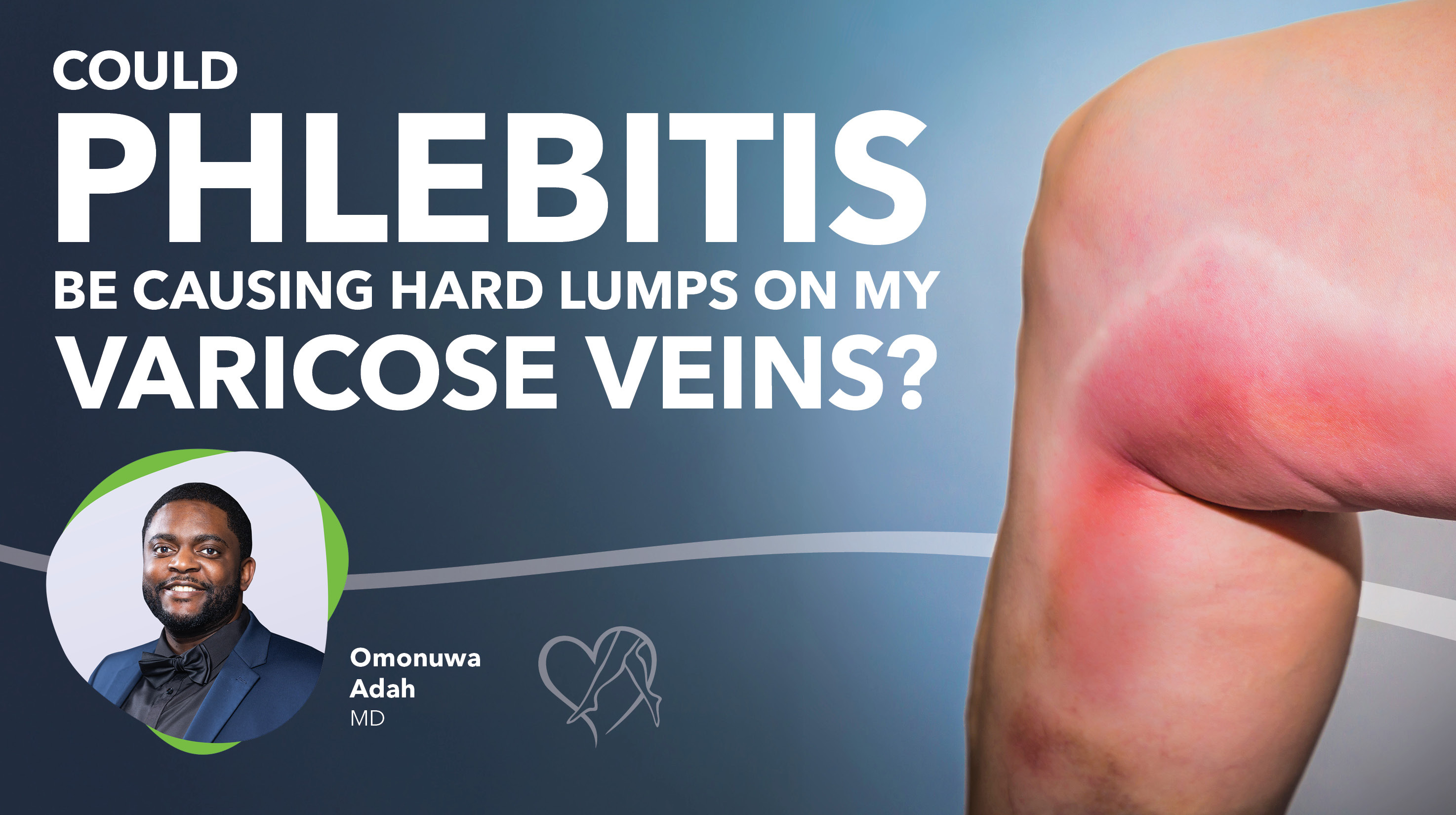 Blog Image Could Phlebitis Be Causing Hard Lumps Thumbnail