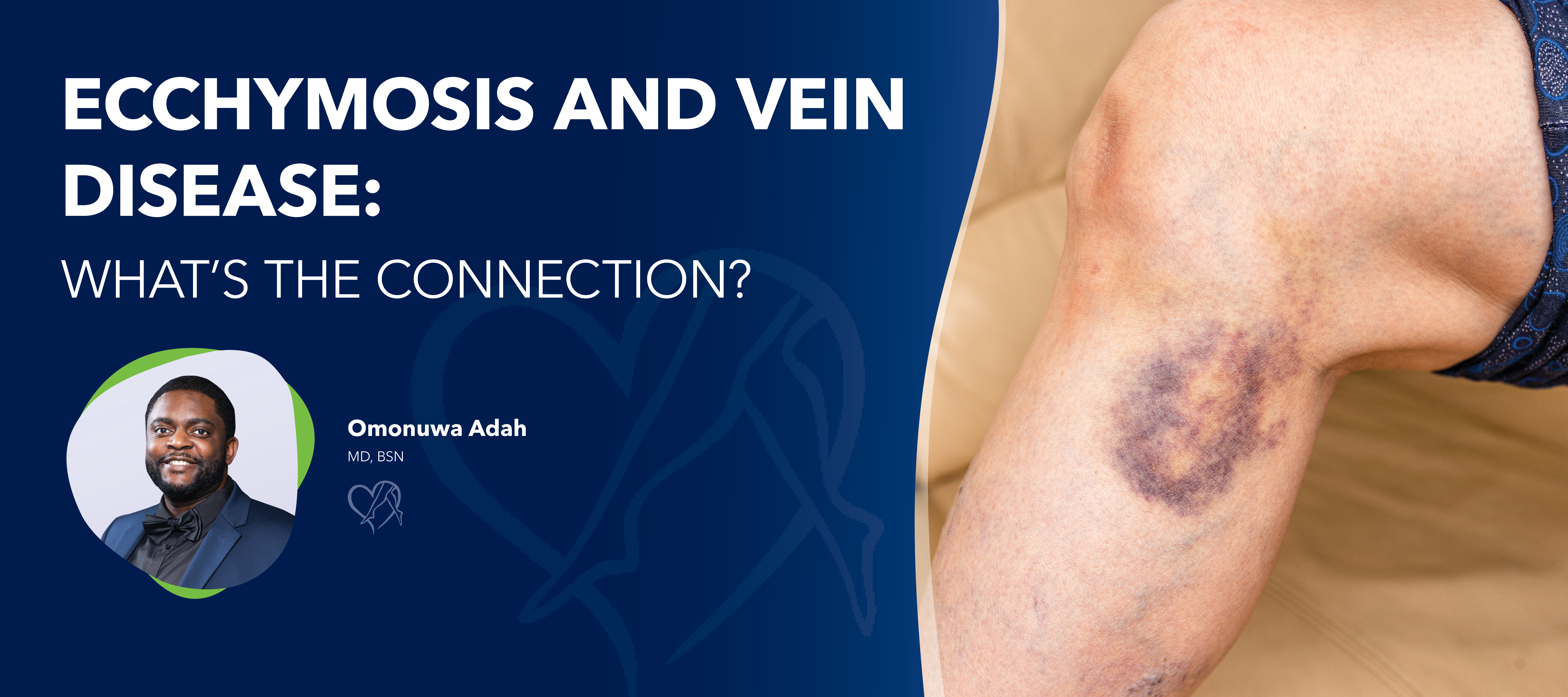 Blog Image Ecchymosisand Vein Disease