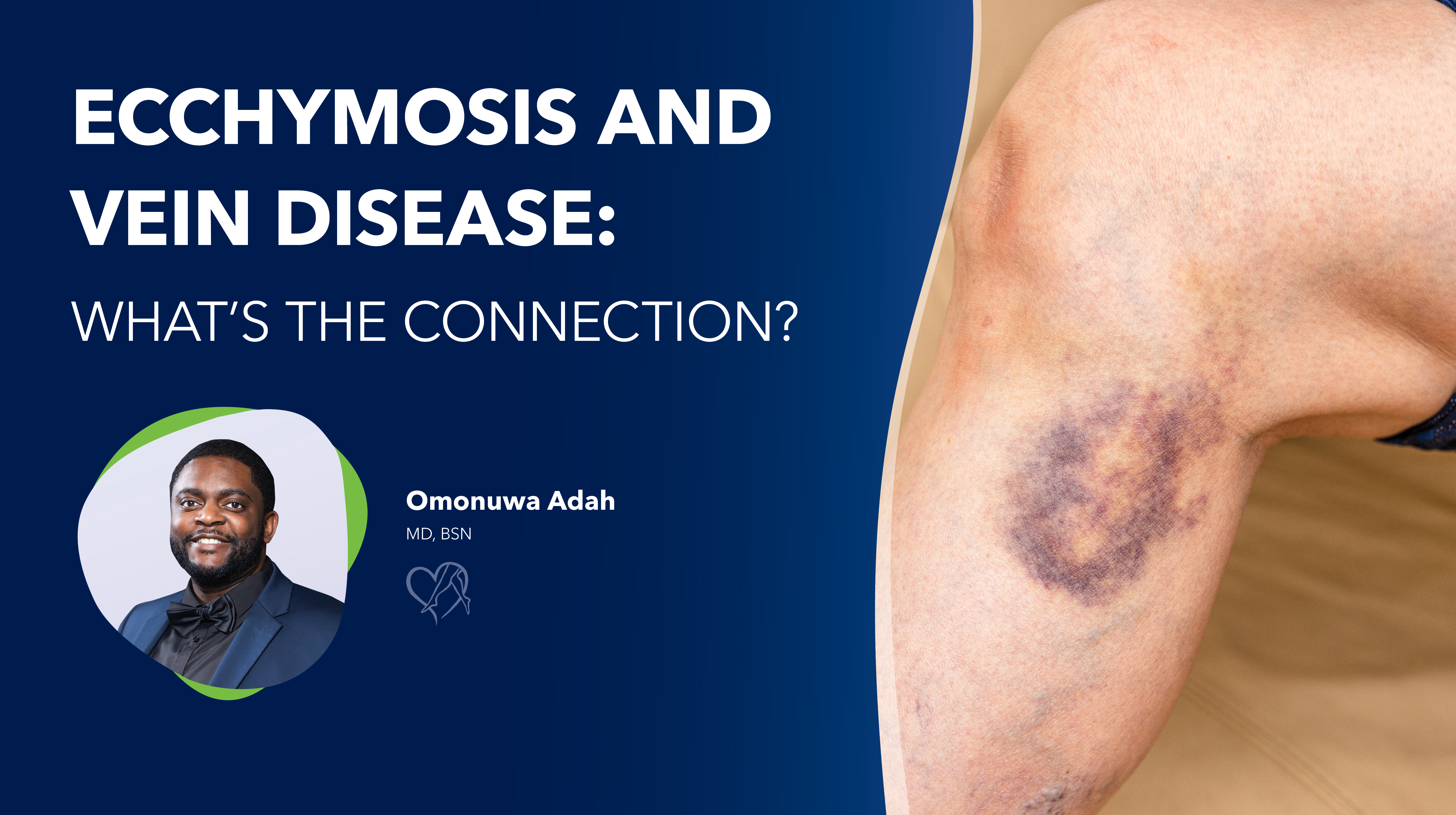 Blog Image Ecchymosisand Vein Disease Thumbnail