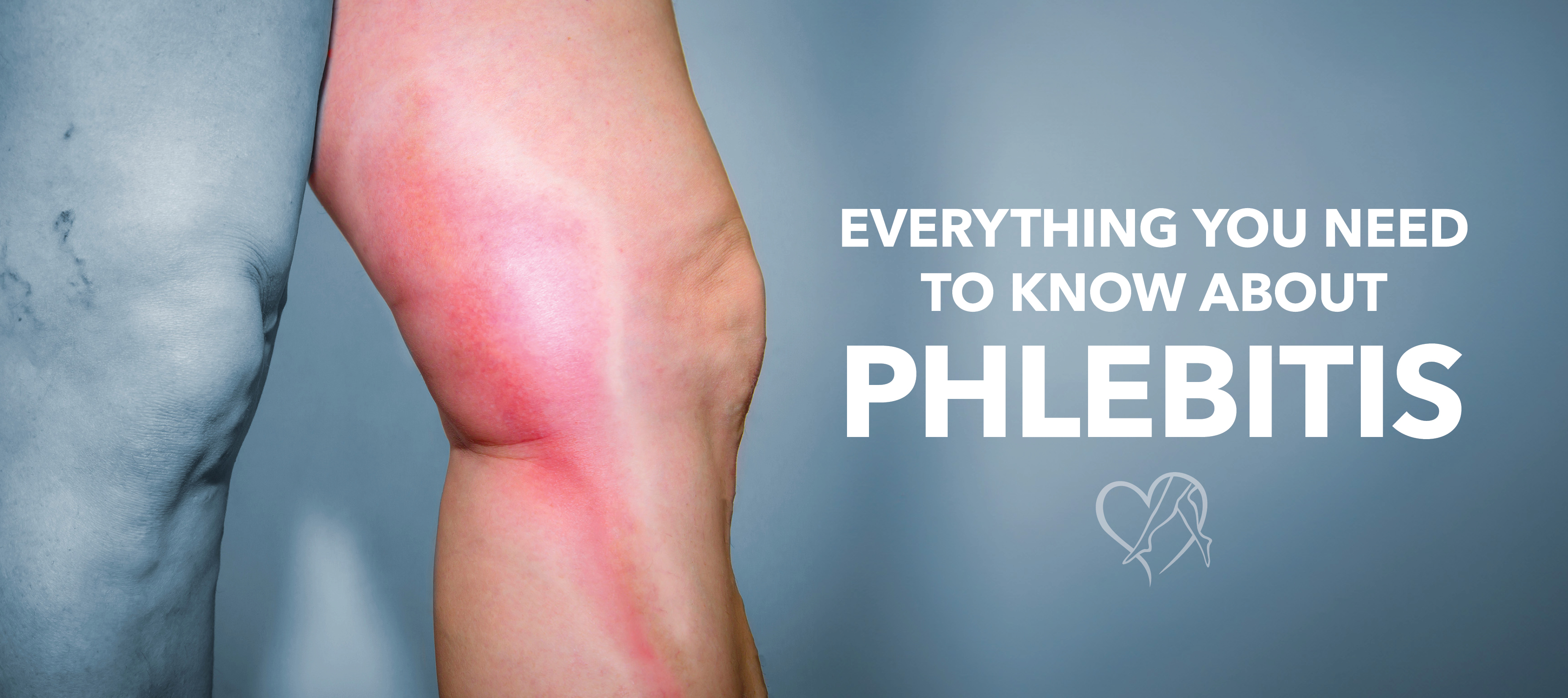 Blog Image Everything You Needto Know About Phlebitis 1