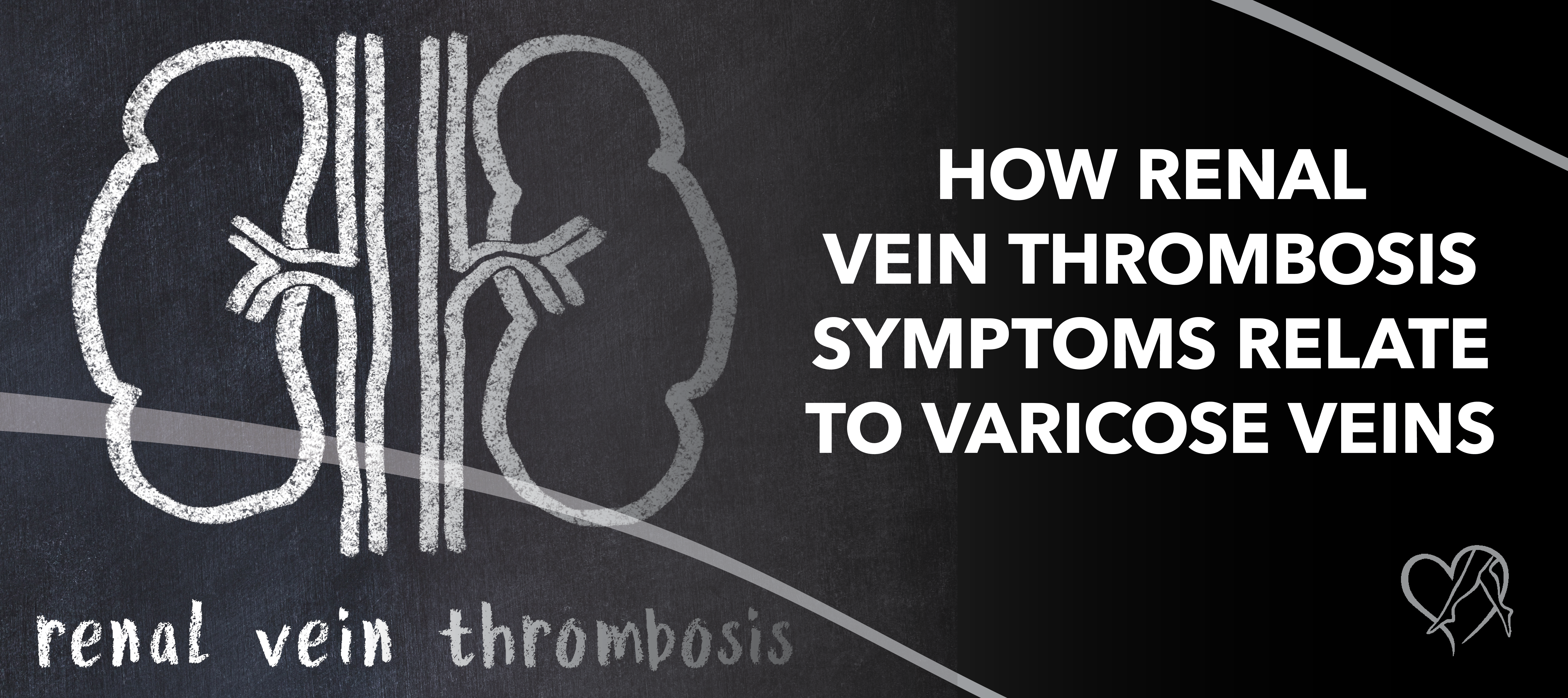 Blog Image How Renal Vein Thrombosis Symptoms Relate to Varicose Veins