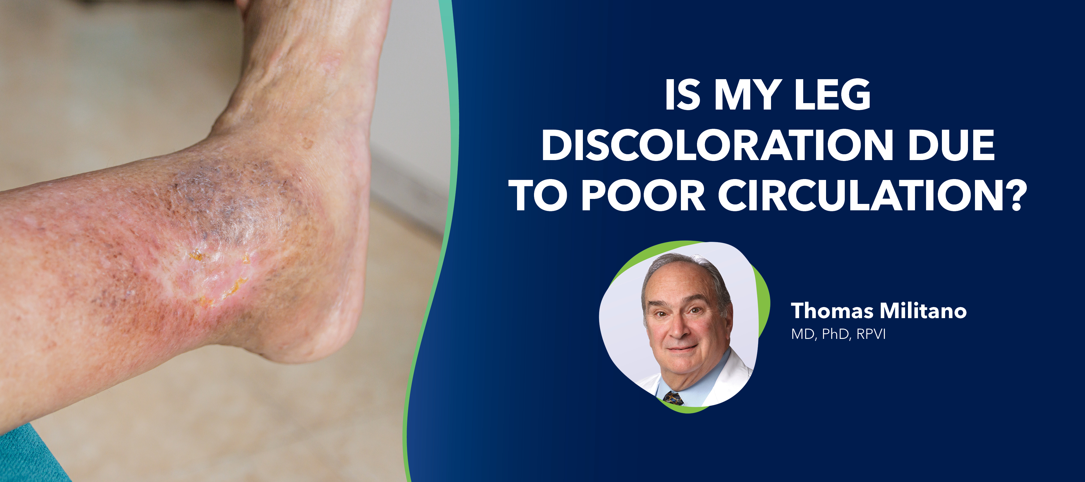 Blog Image Is My Leg Discoloration Due to Poor Circulation