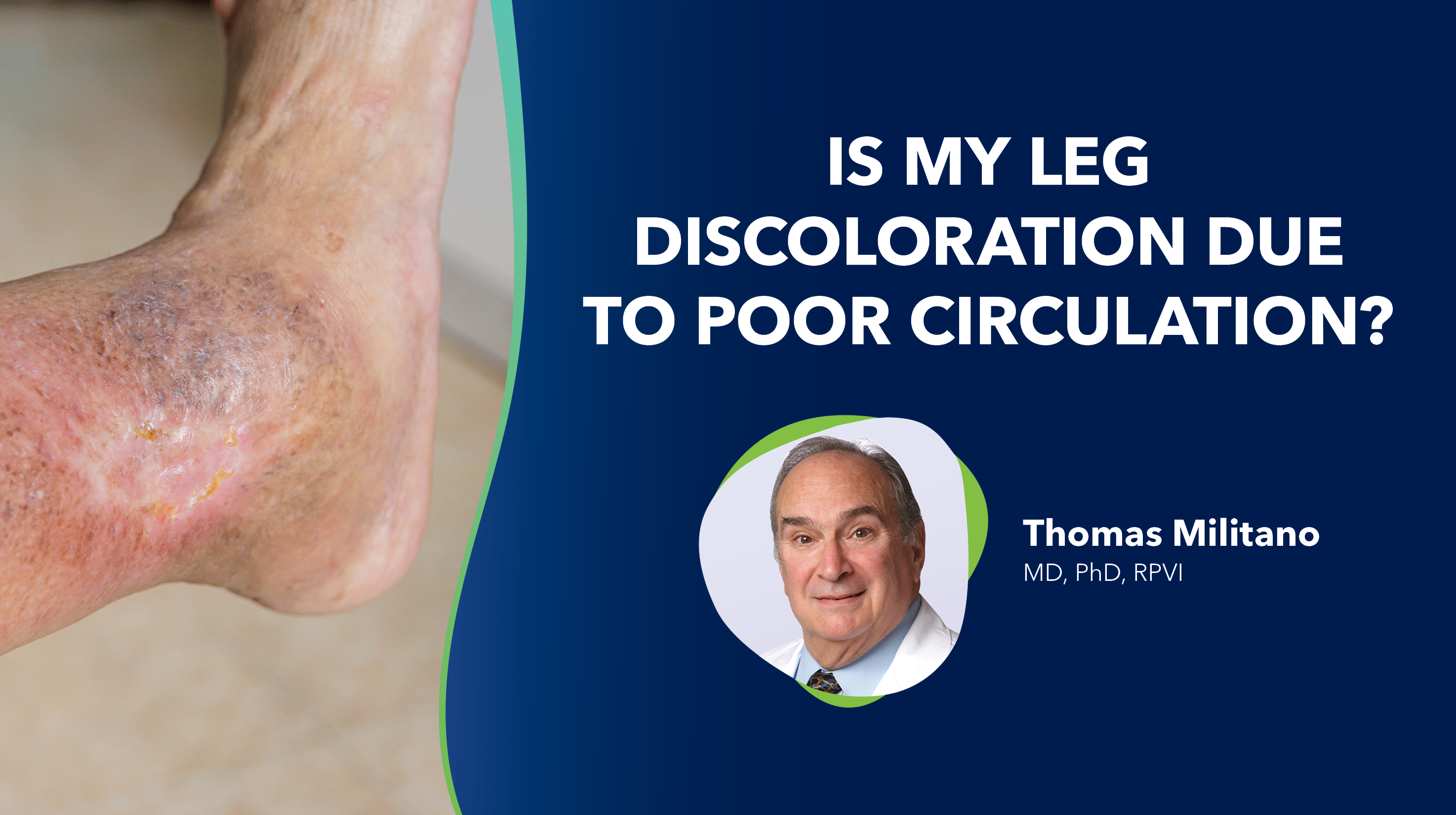 Blog Image Is My Leg Discoloration Due to Poor Circulation Thumbnail
