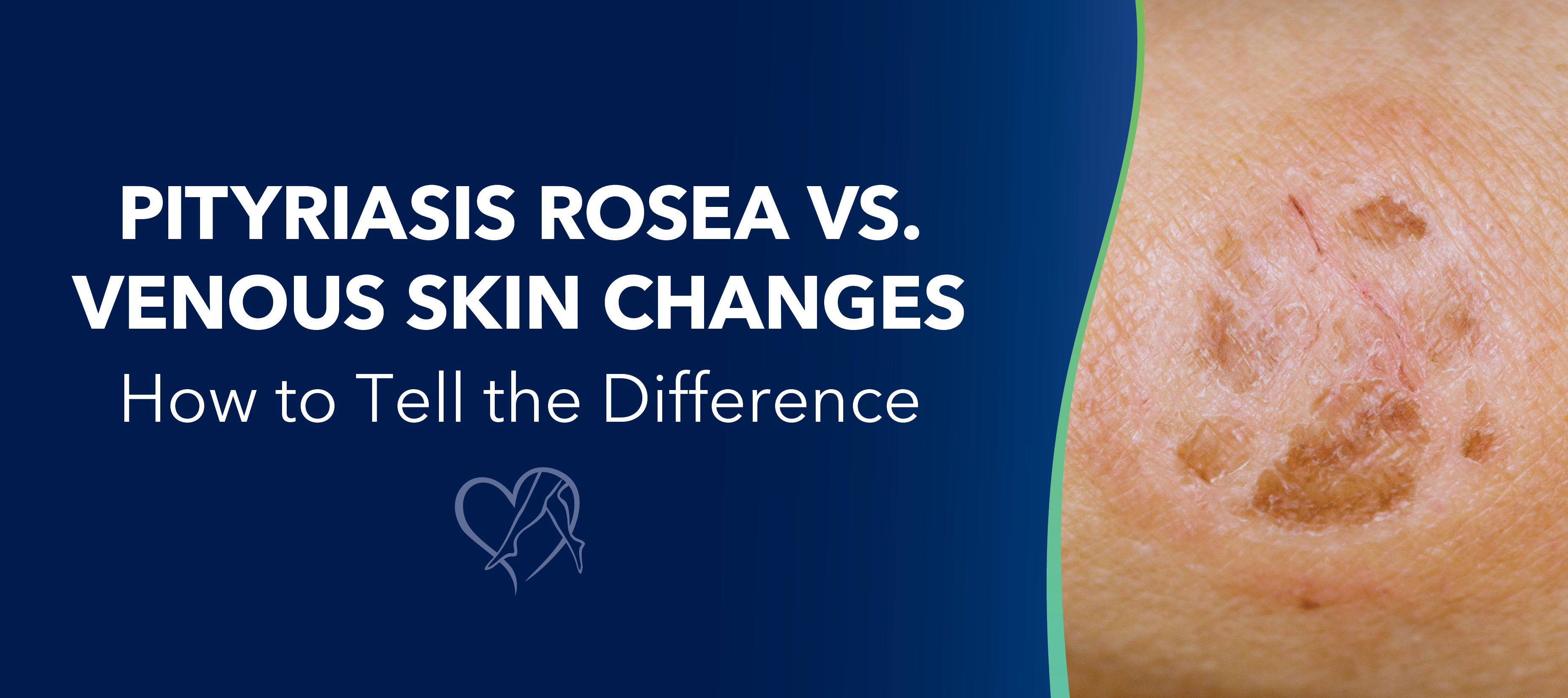 Blog Image Pityriasis Rosea