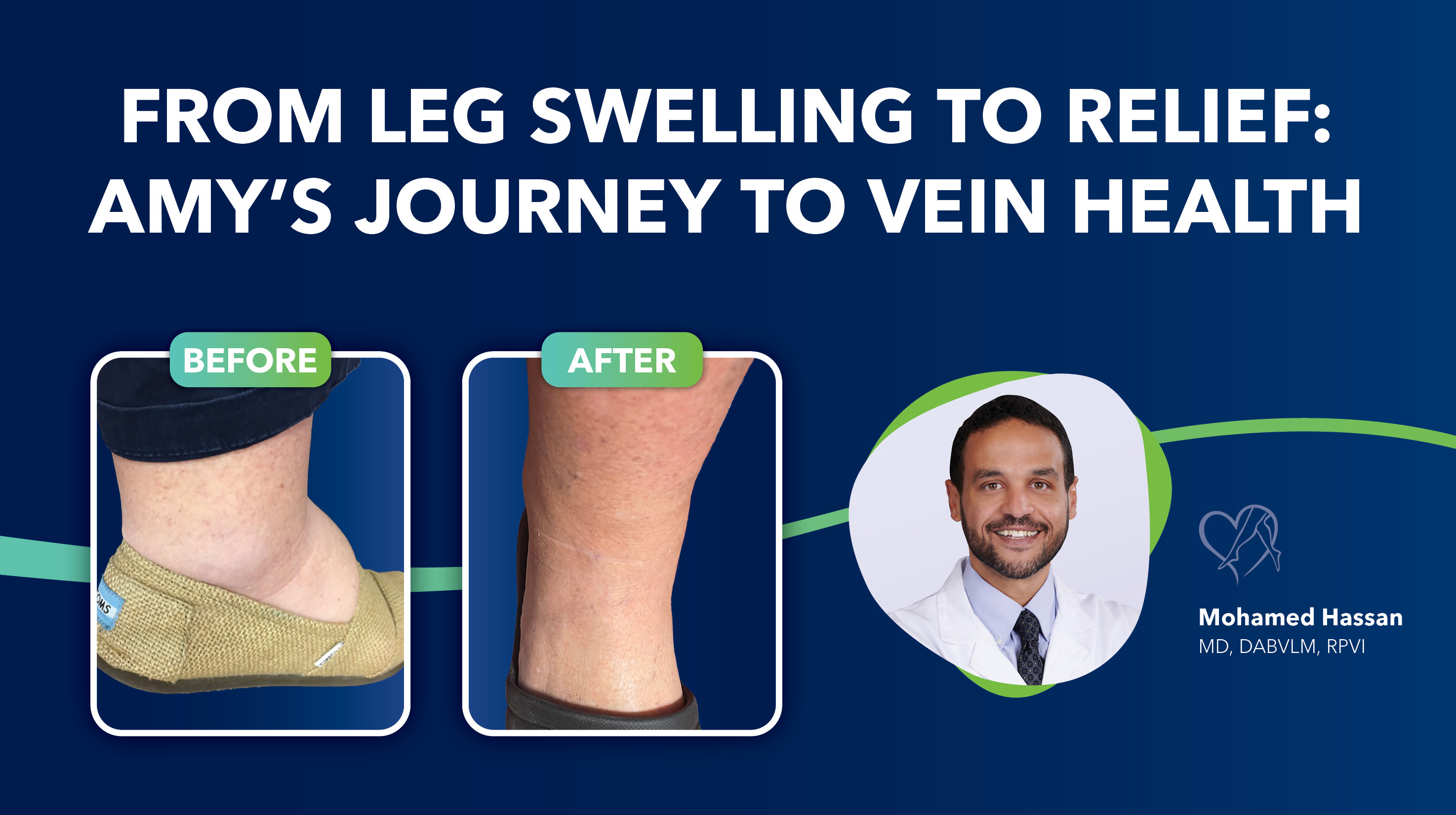 Blog Image Pt Story From Leg Swelling to Relief Amys Journey to Vein Health Thumbnail