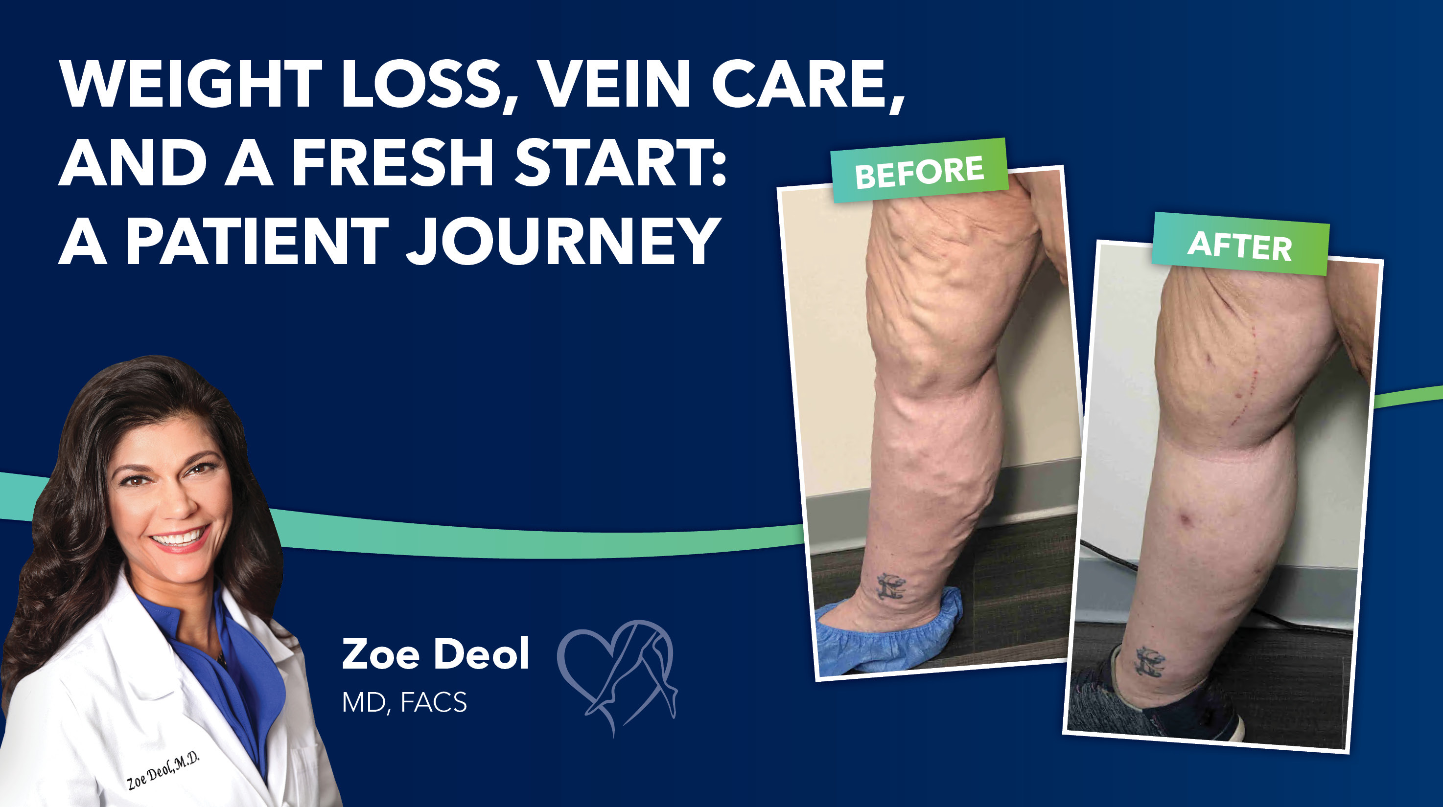 Blog Image Pt Story Weight Loss Vein Care Fresh Start Thumbnail
