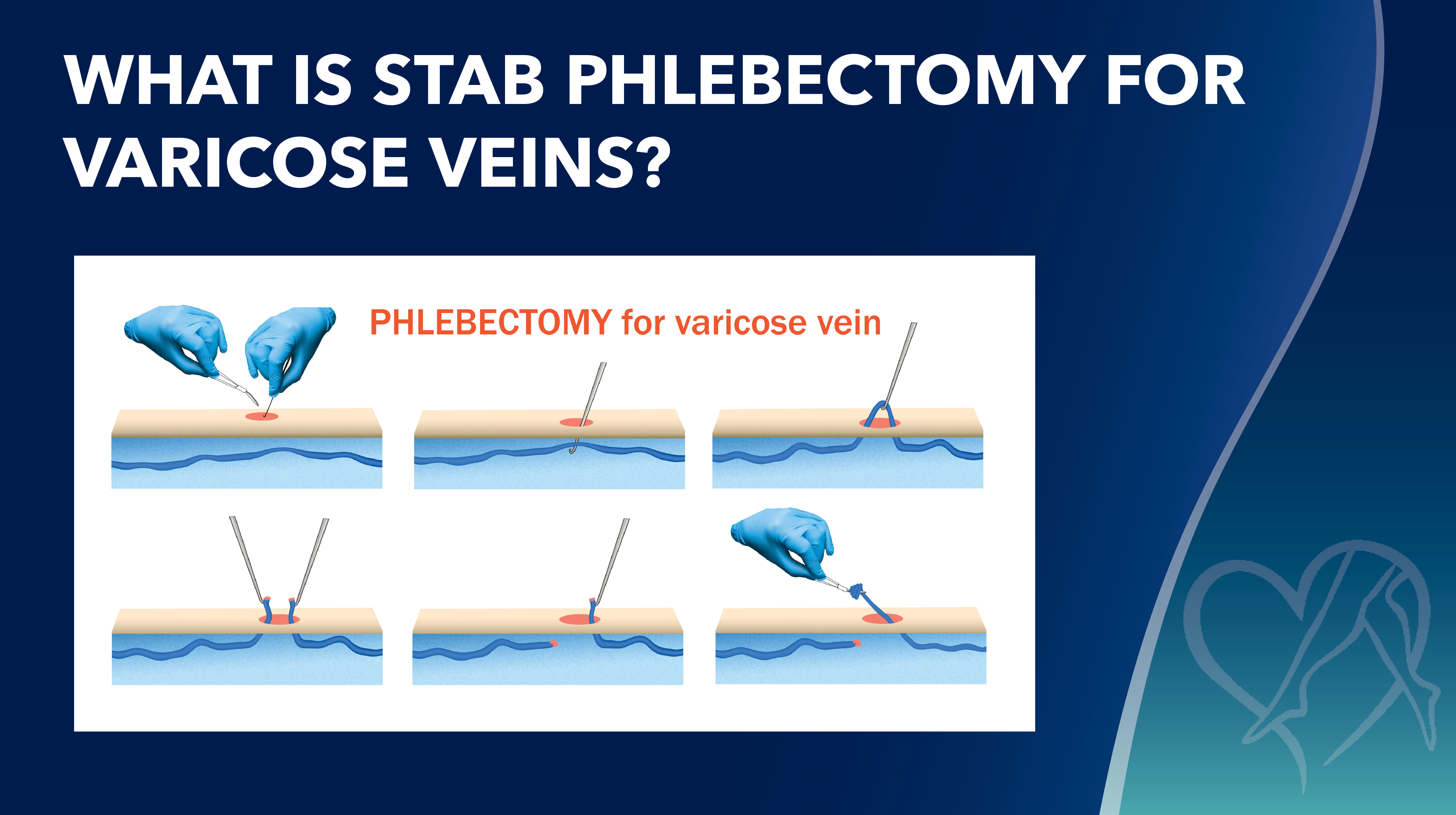 Blog Image Pt Story Whatis Stab Phlebectomy For Varicose Veins Thumbnail