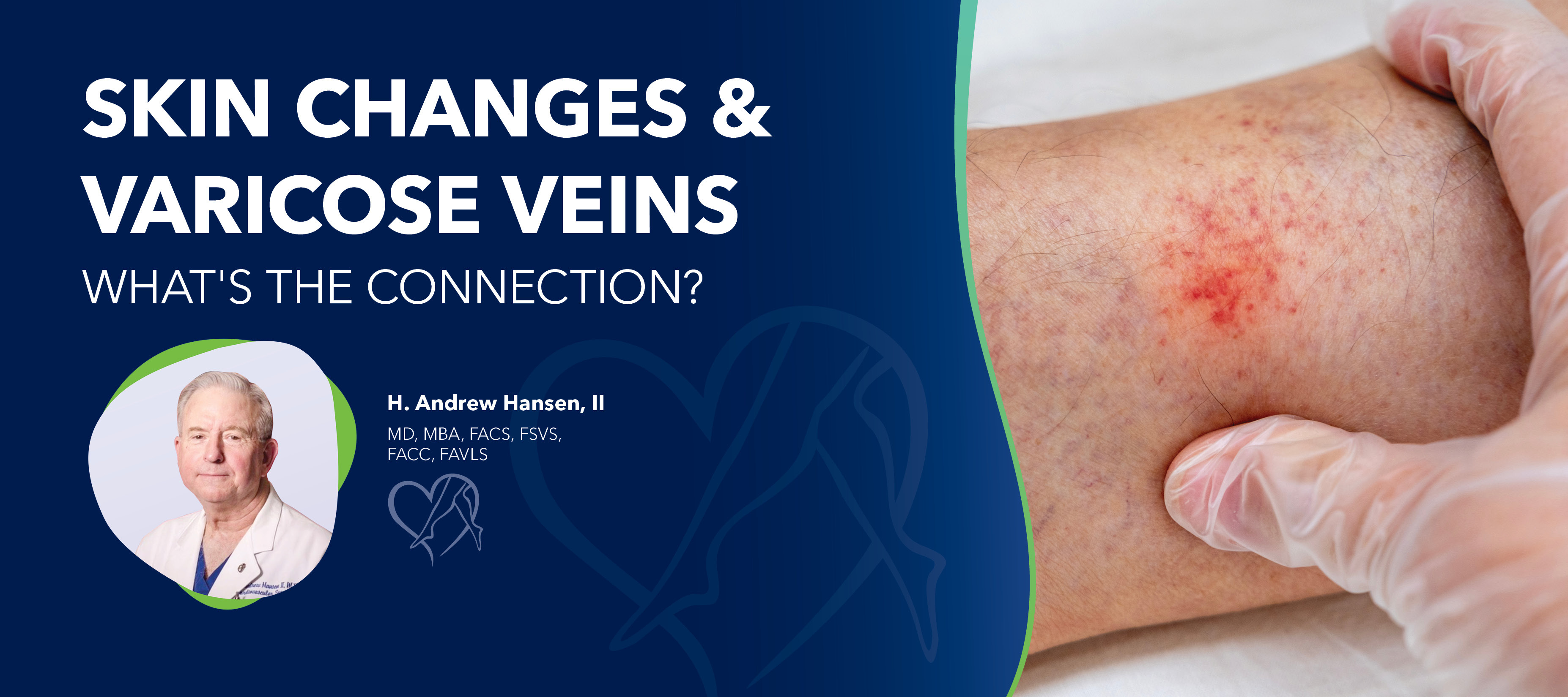 Blog Image Skin Changes And Varicose Veins