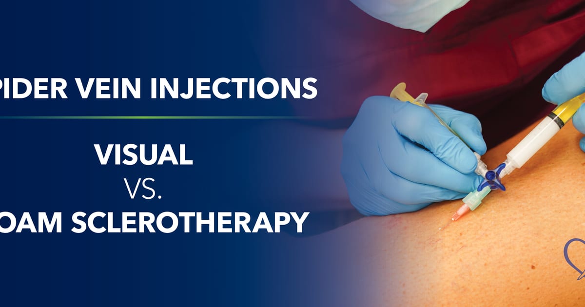 Spider Vein Injections: Visual vs. Foam Sclerotherapy