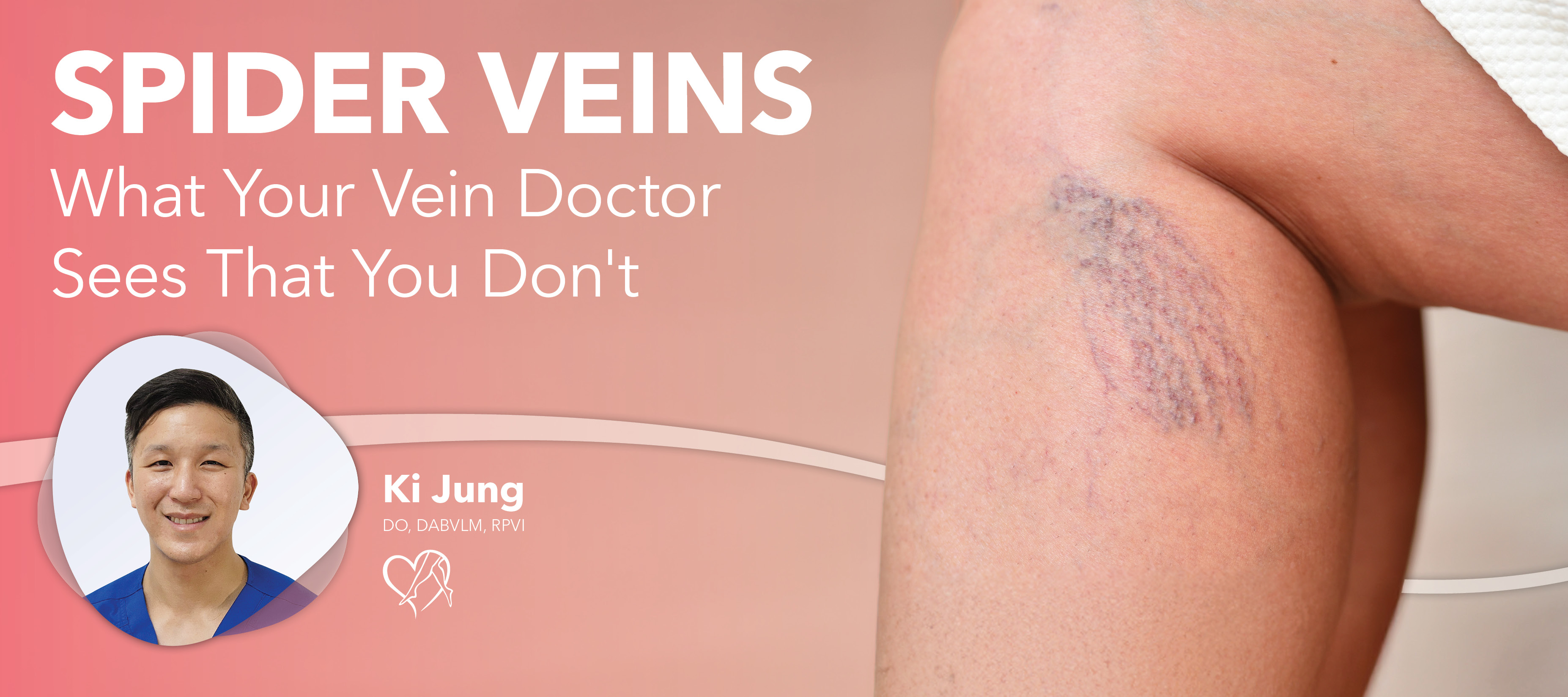 Blog Image Spider Veins