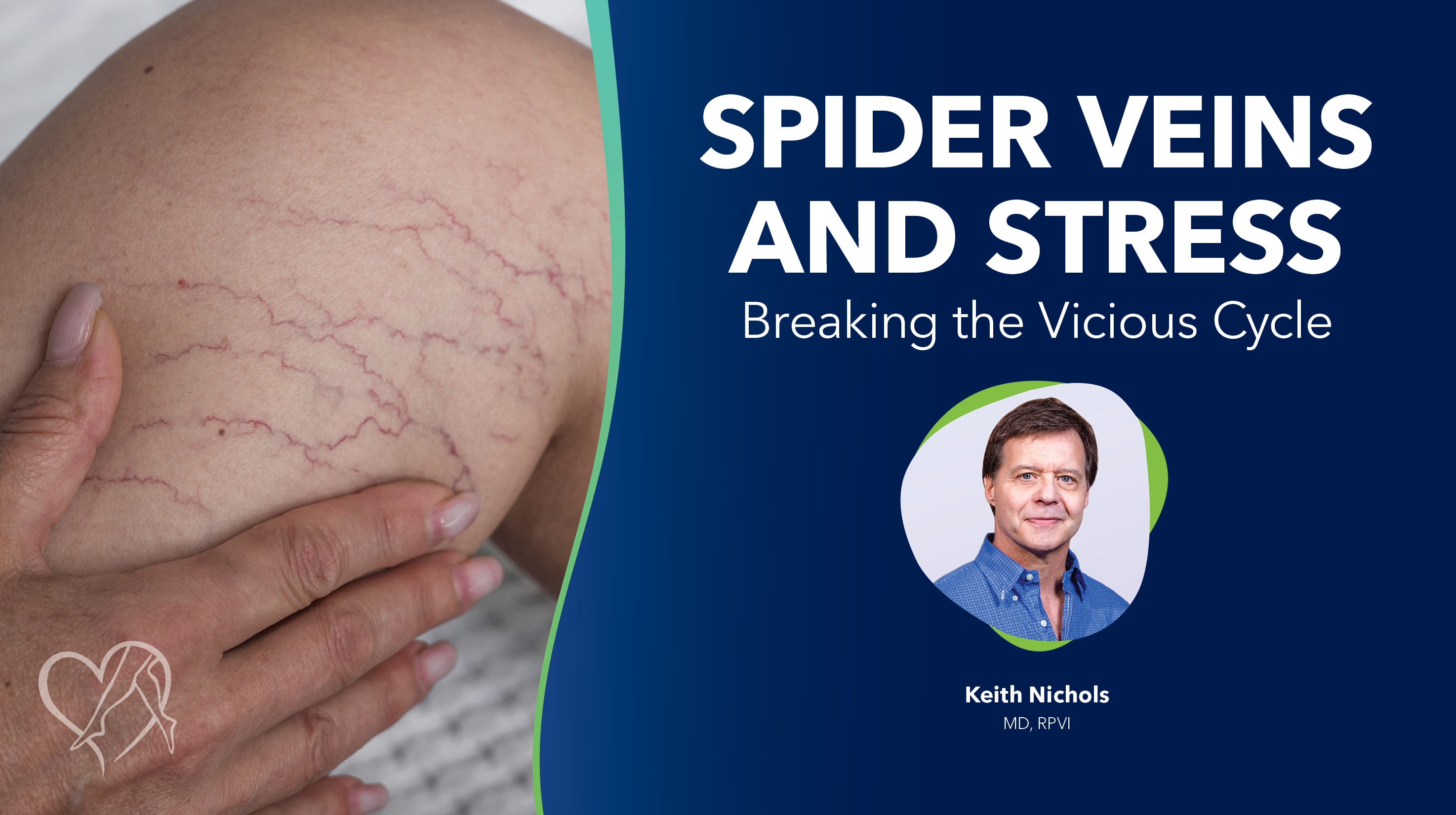 Blog Image Spider Veins And Stress Thumbnail