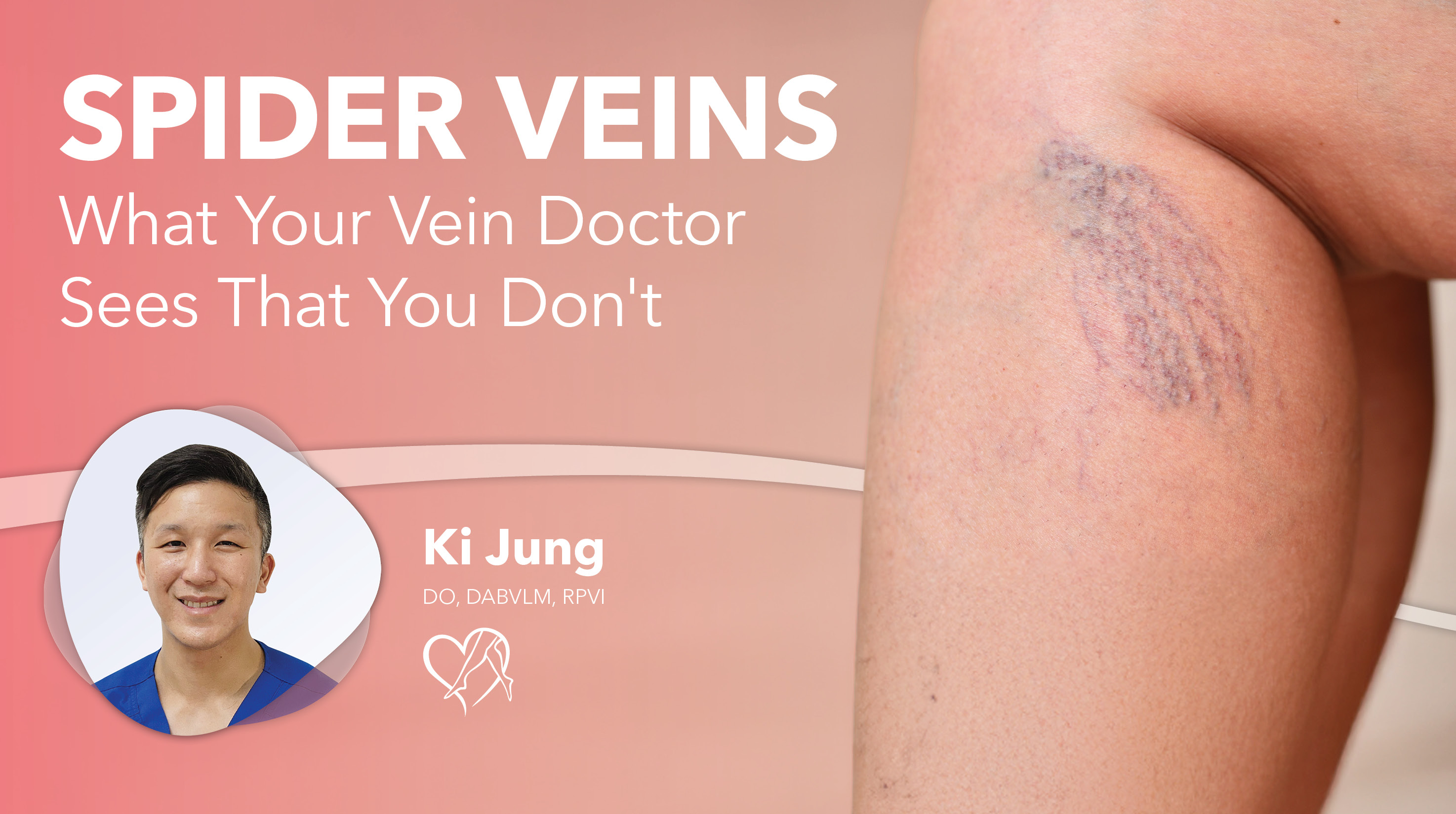Blog Image Spider Veins Thumbnail