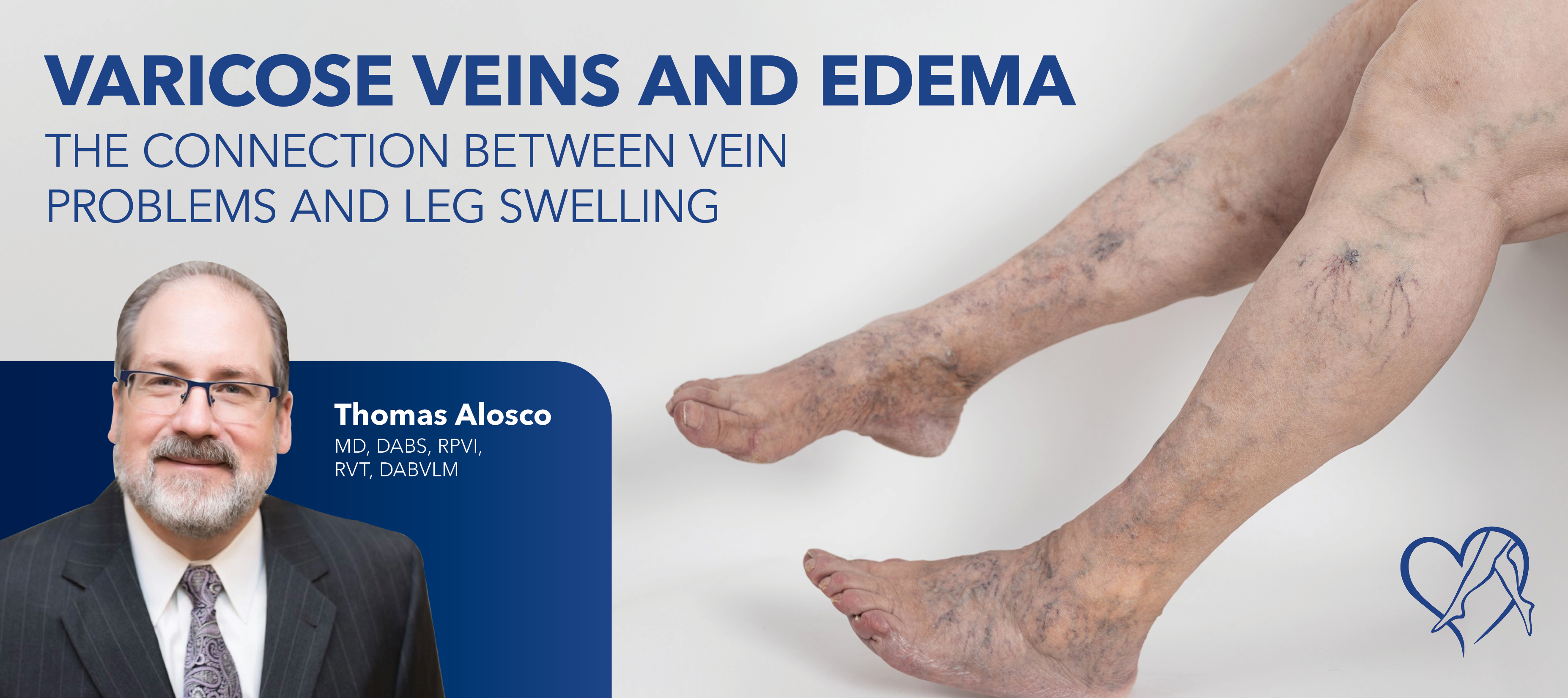Blog Image Varicose Veins And Edema