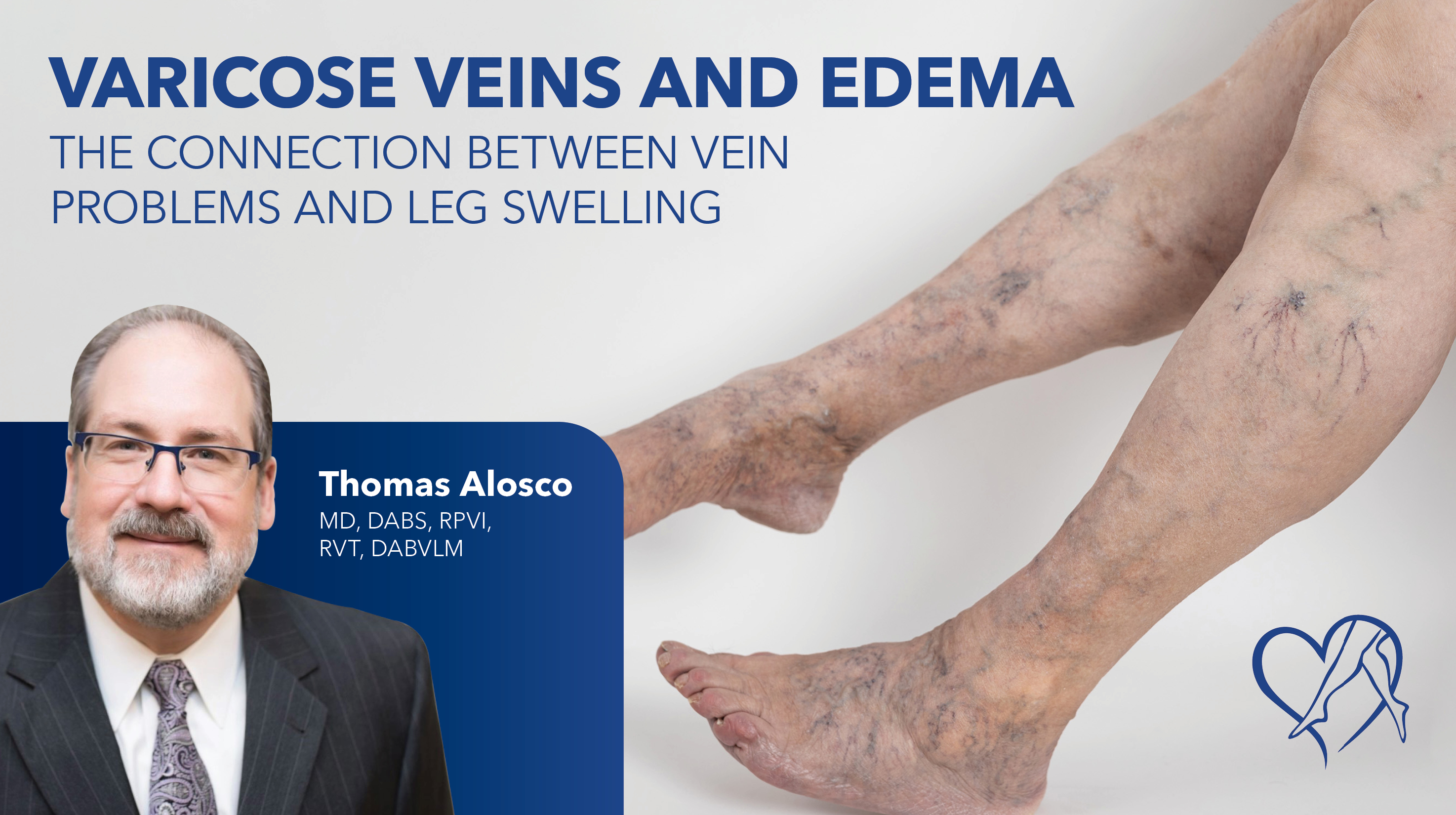 Blog Image Varicose Veins And Edema Thumbnail