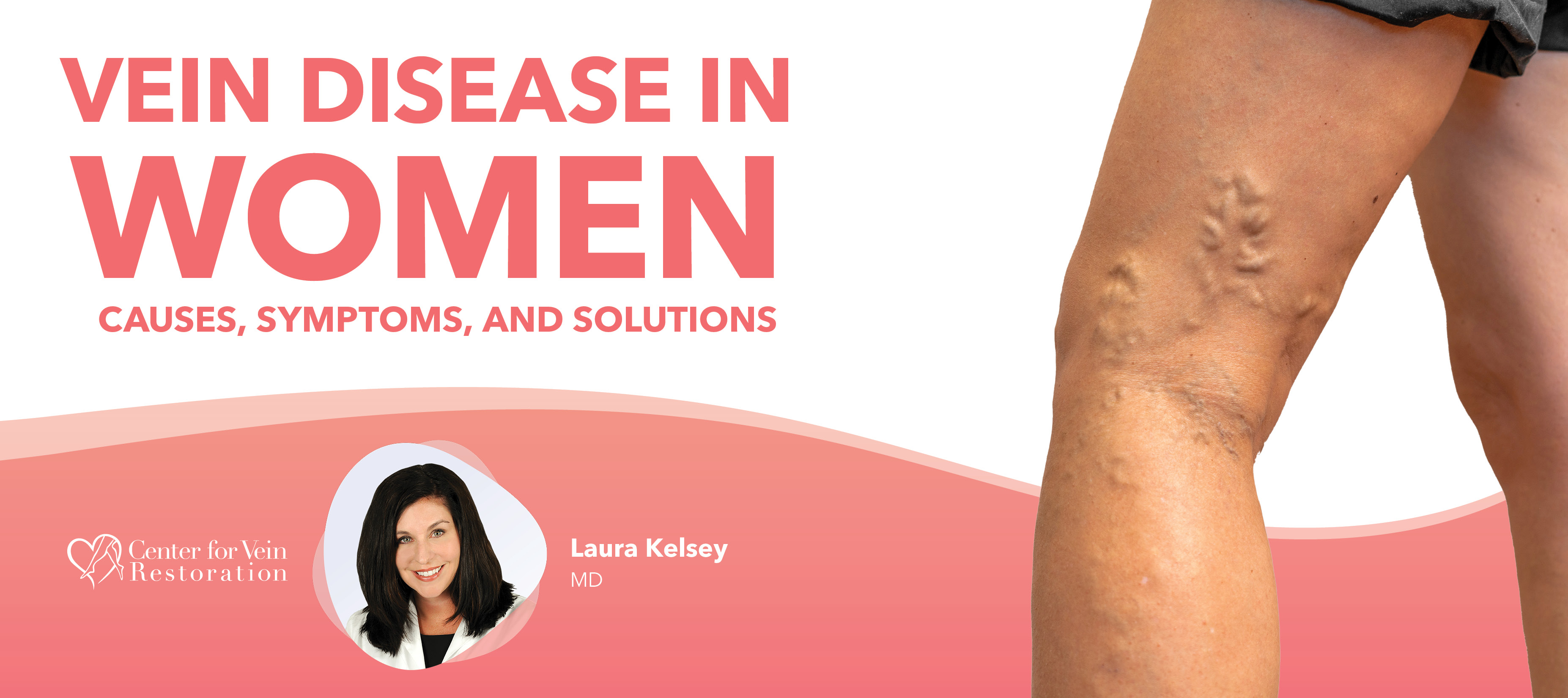 Blog Image Vein Disease In Women