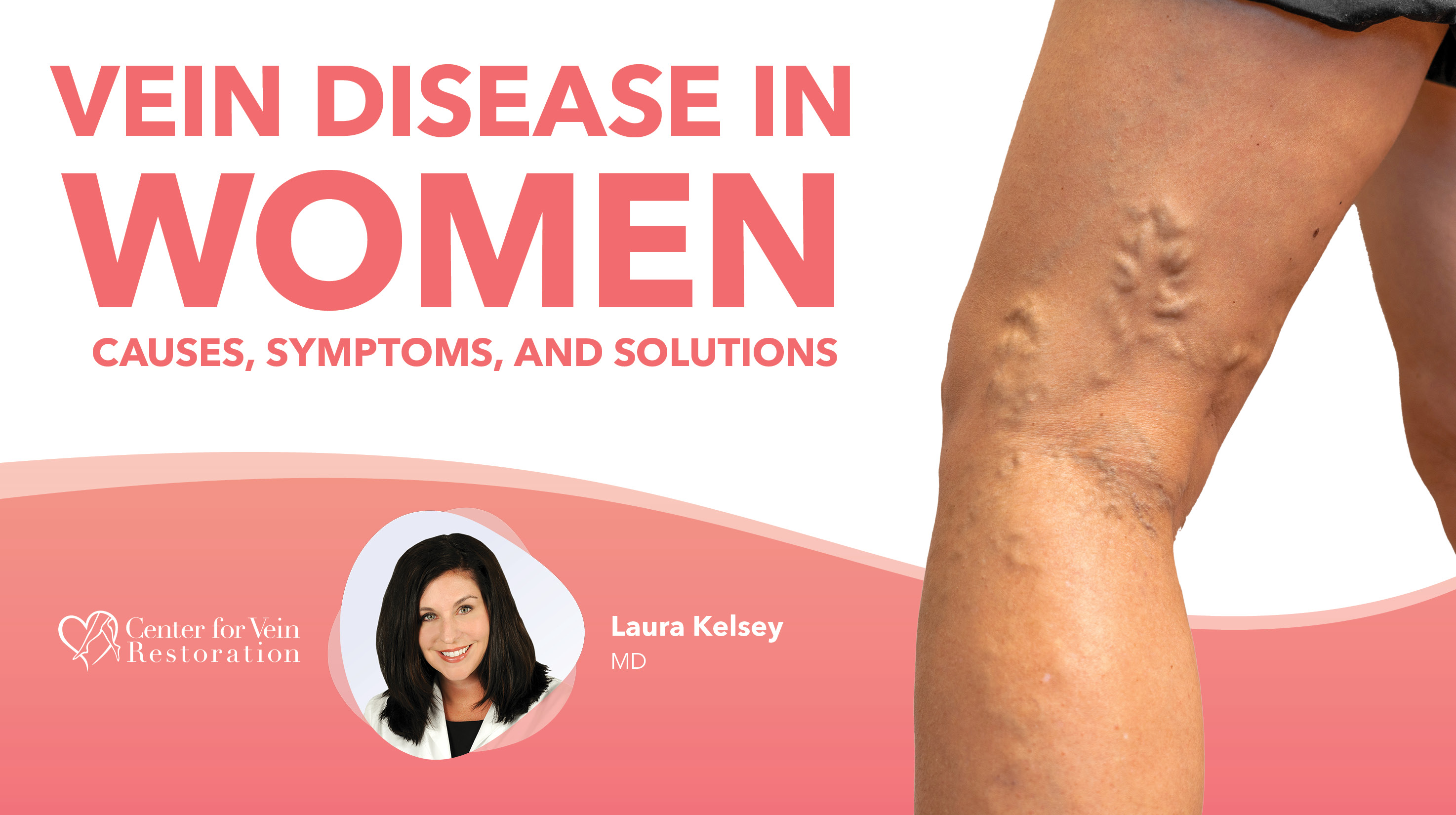 Blog Image Vein Disease In Women Thumbnail