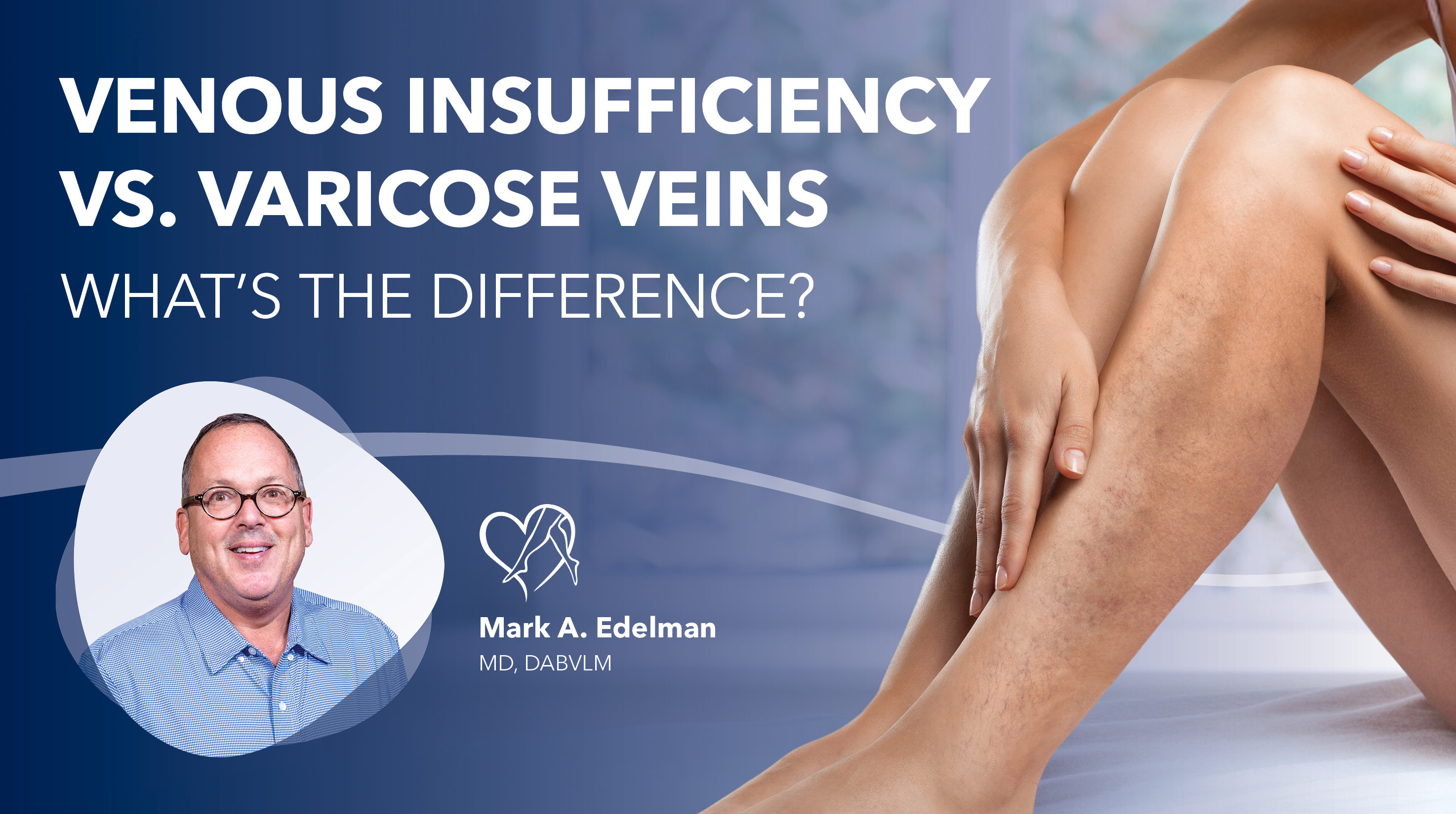 Blog Image Venous Insufficiency Vs Varicose Veins Thumbnail