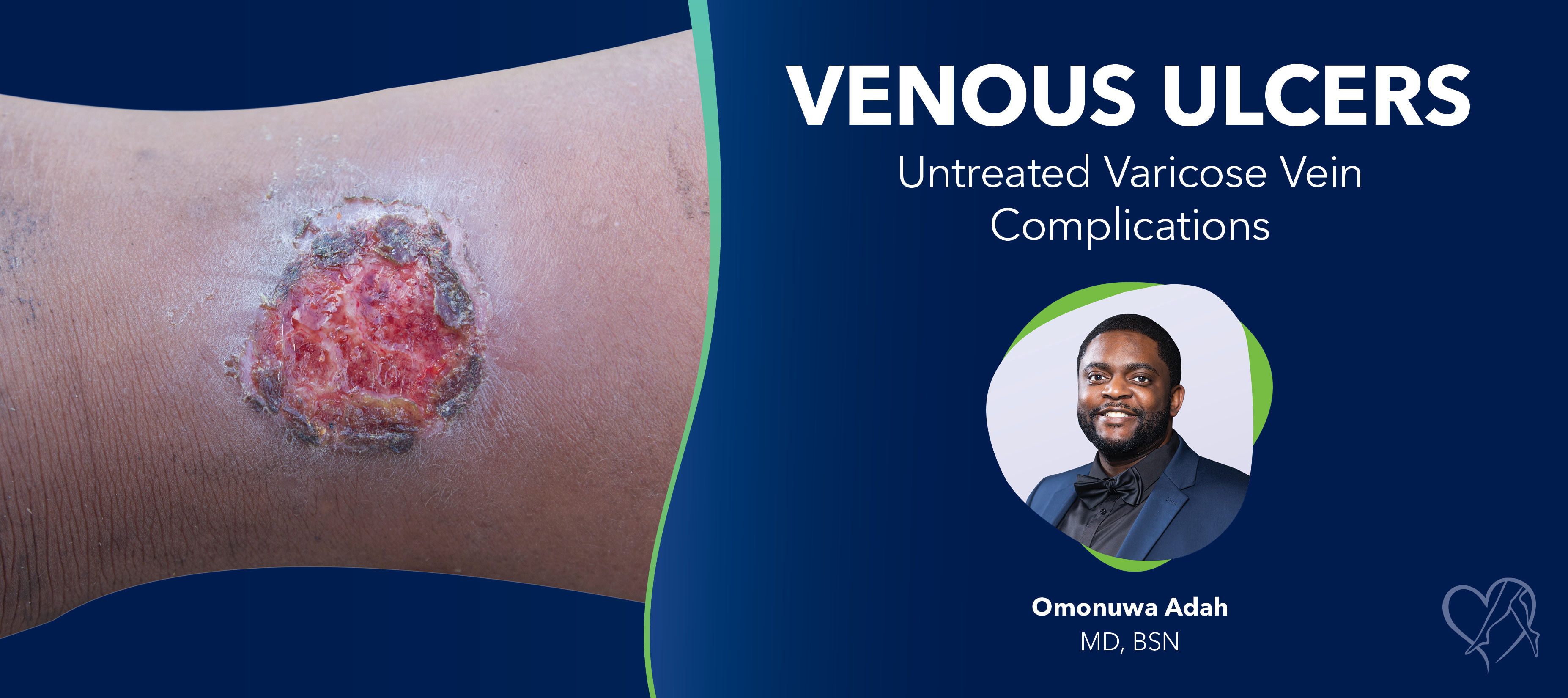 Blog Image Venous Ulcers