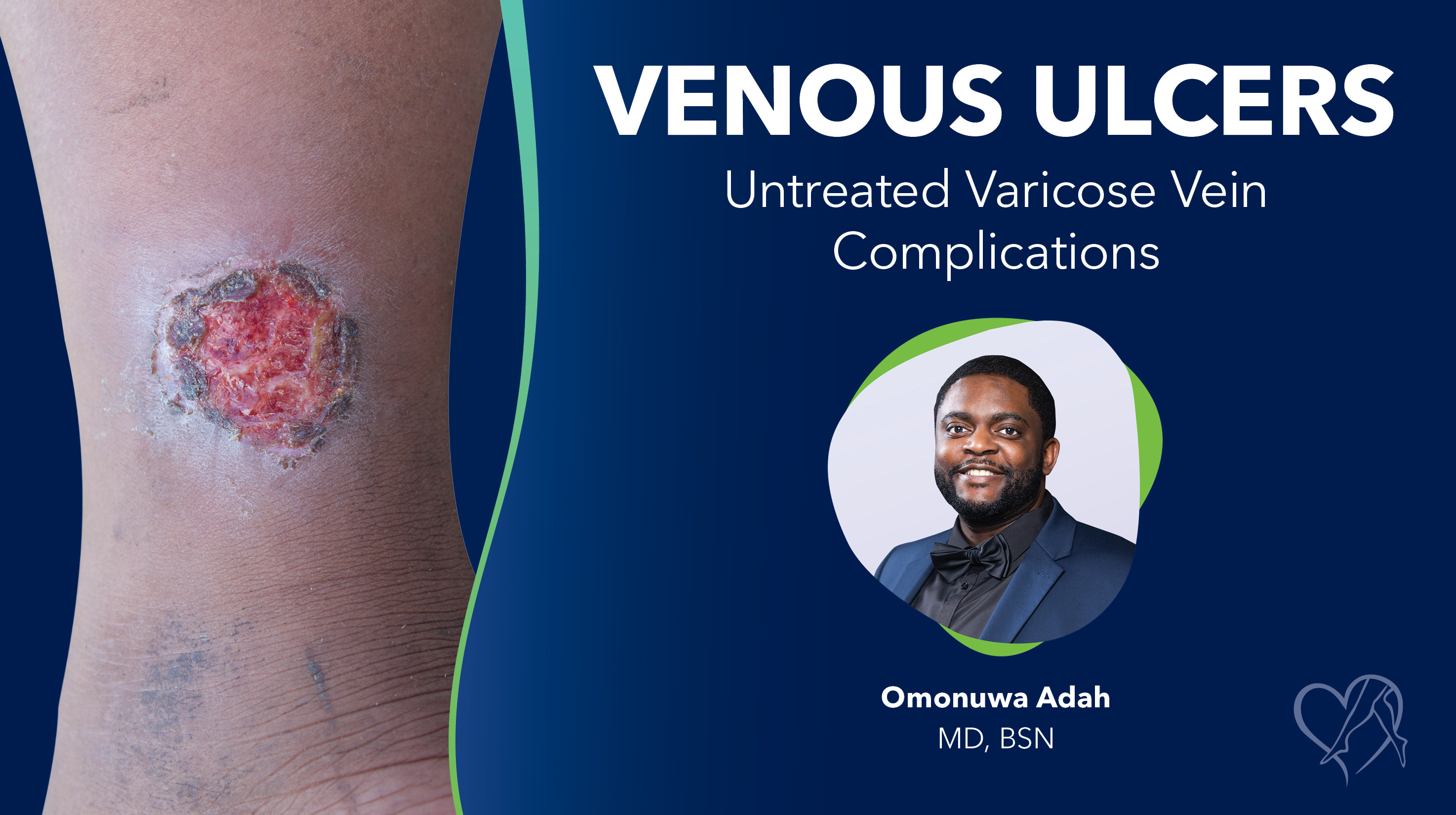 Blog Image Venous Ulcers Thumbnail