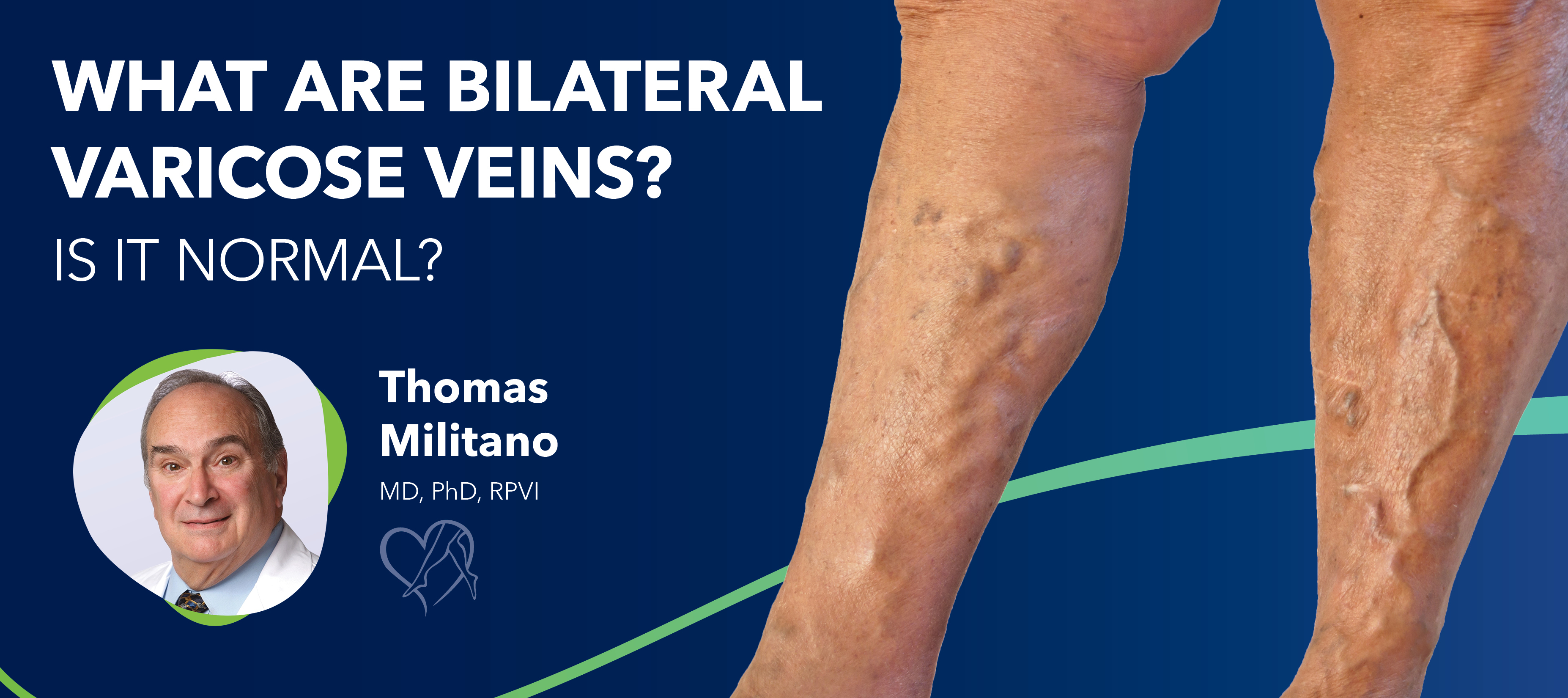 Blog Image What Are Bilateral Varicose Veins