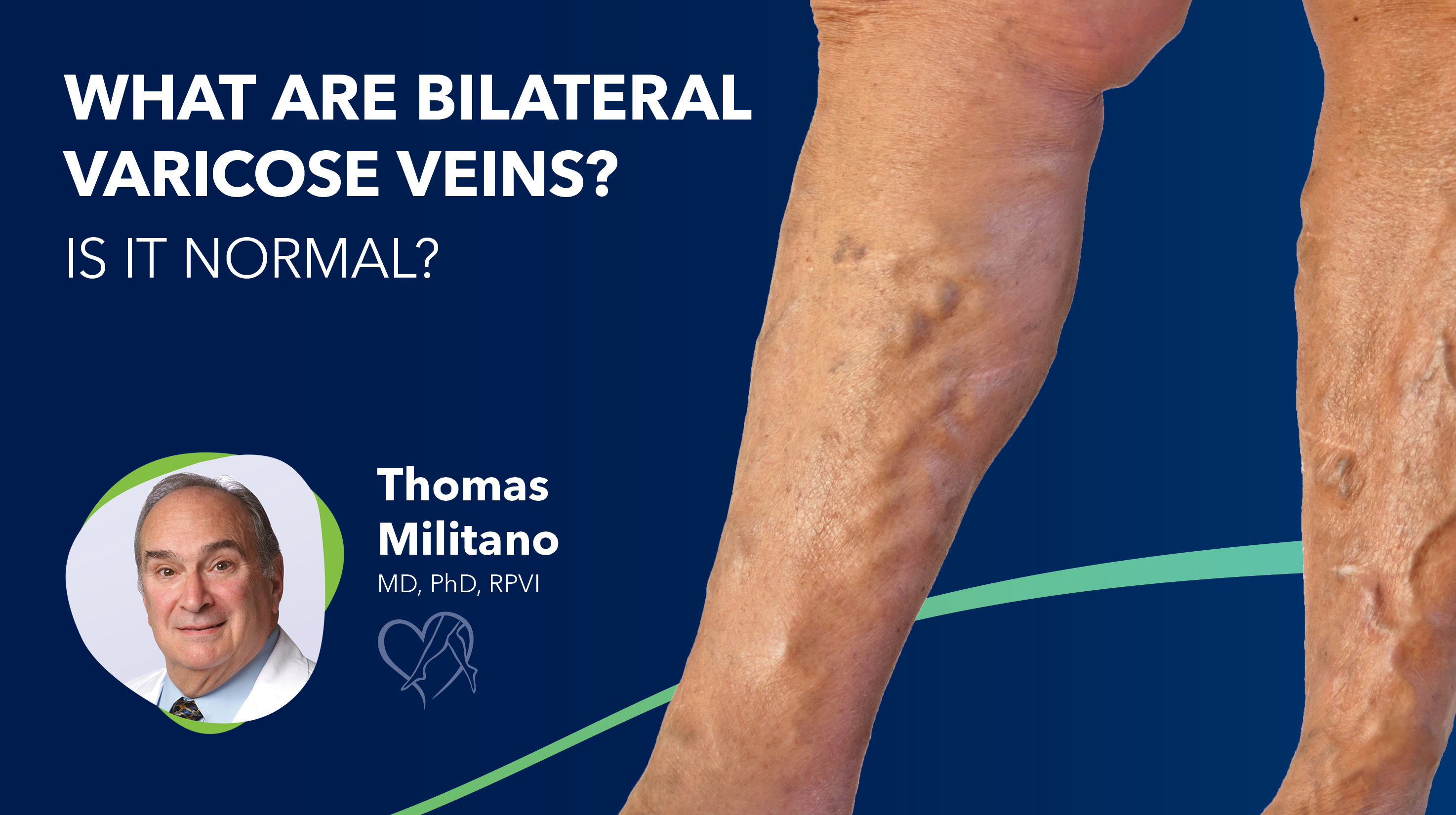 Blog Image What Are Bilateral Varicose Veins Thumbnail