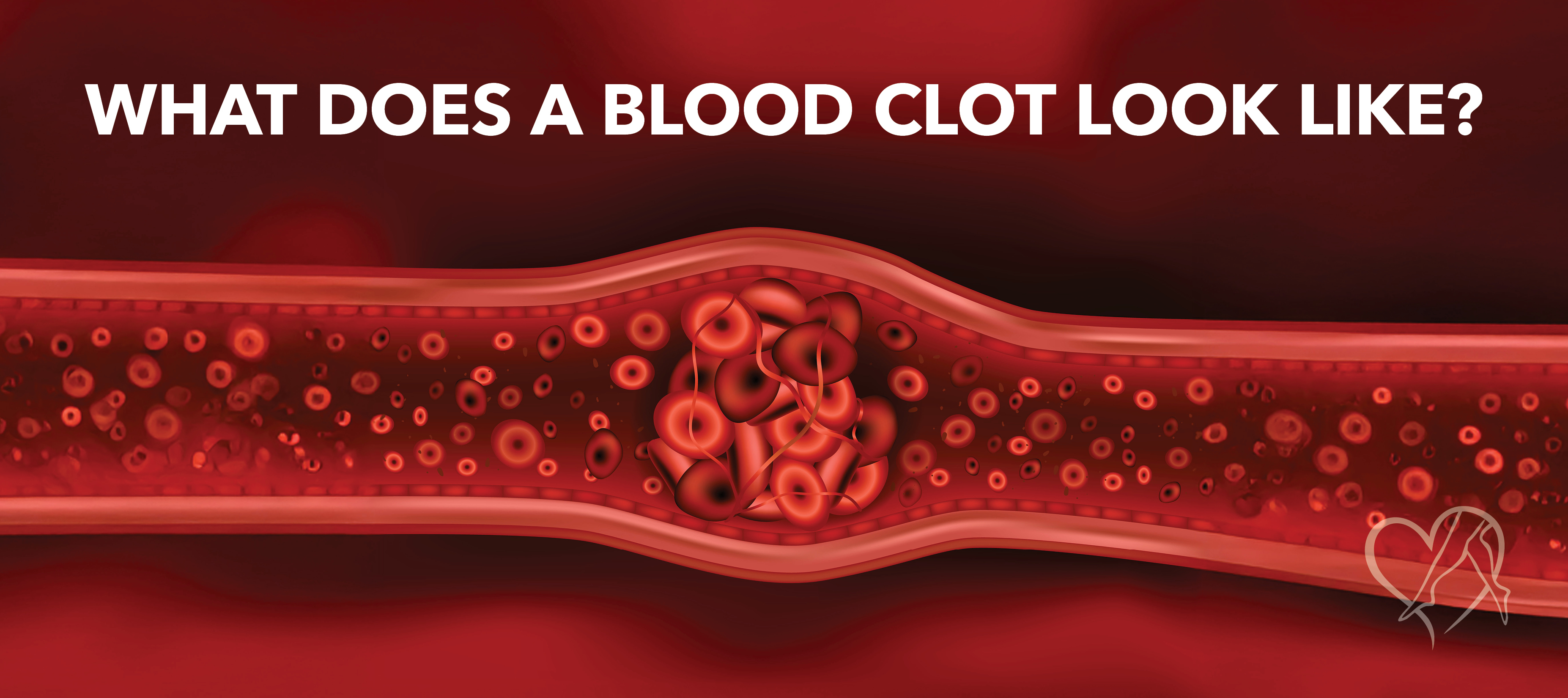 Blog Image What Does A Blood Clot Look Like