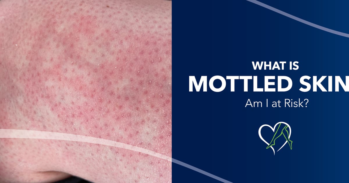 Mottled Examples What is Mottled Skin? Am I at Risk?