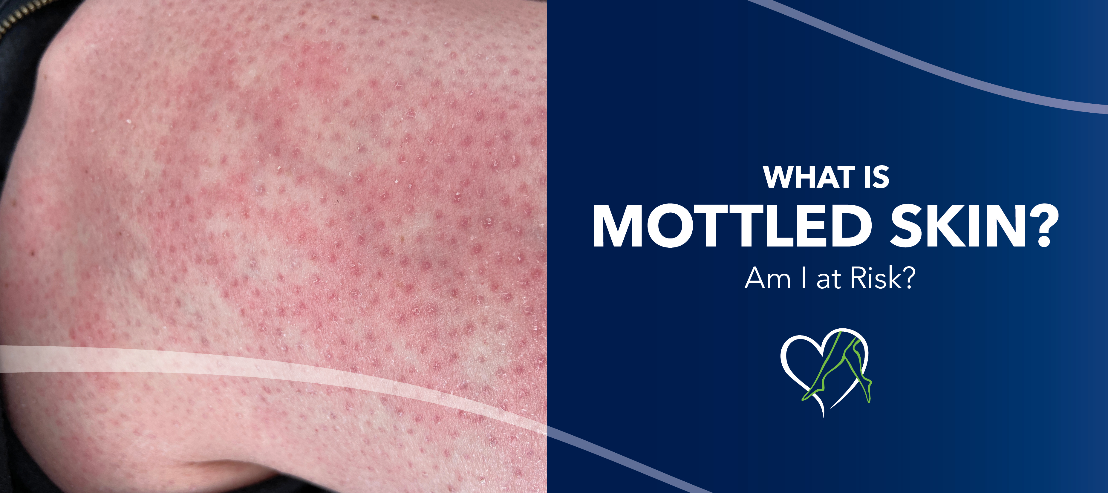 Blog Image What Is Mottled Skin