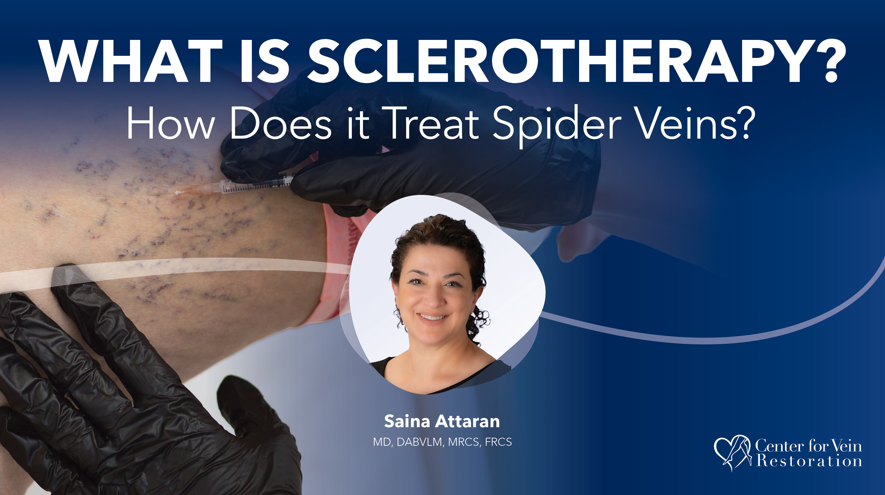 Blog Image What Is Sclerotherapy