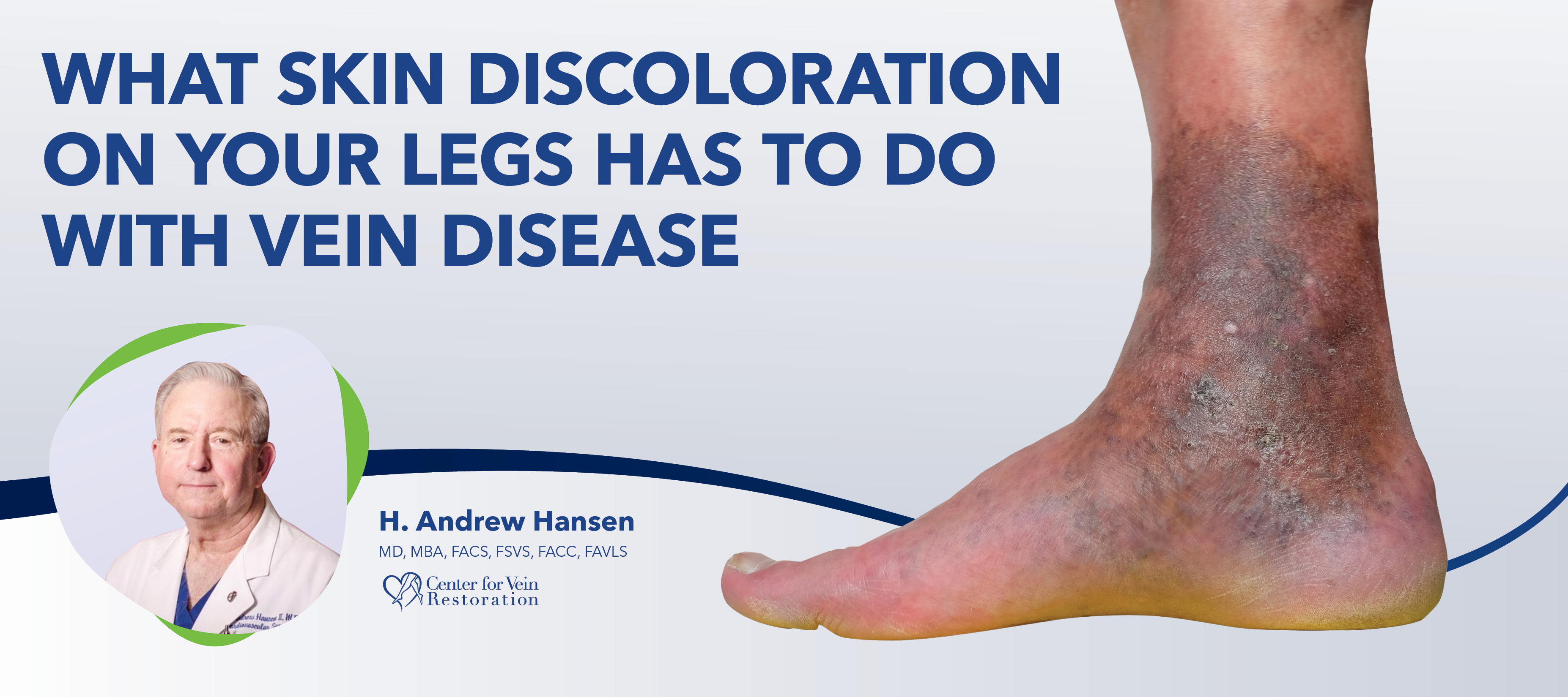 Blog Image What Skin Discoloration On Your Legs