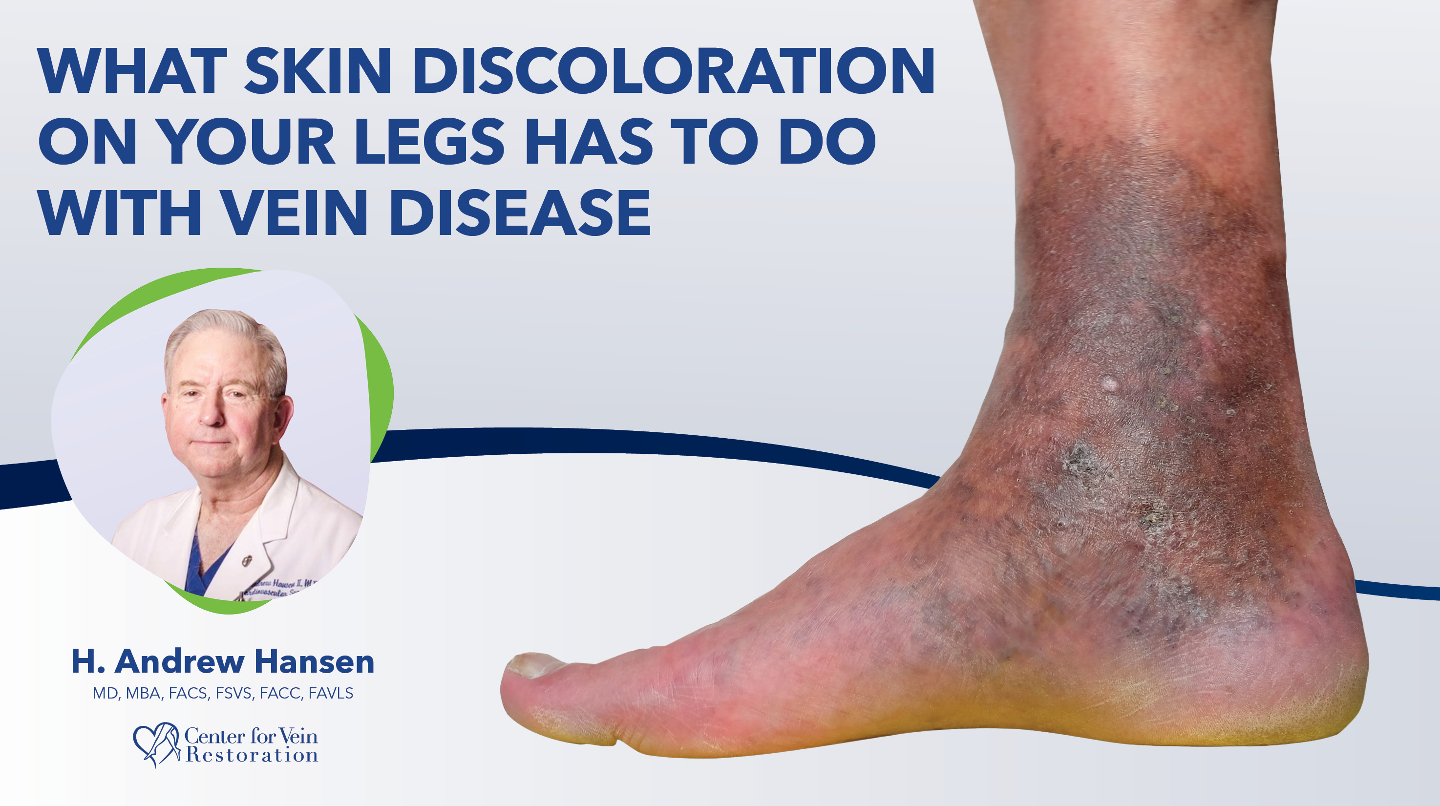 Blog Image What Skin Discoloration On Your Legs Thumbnail